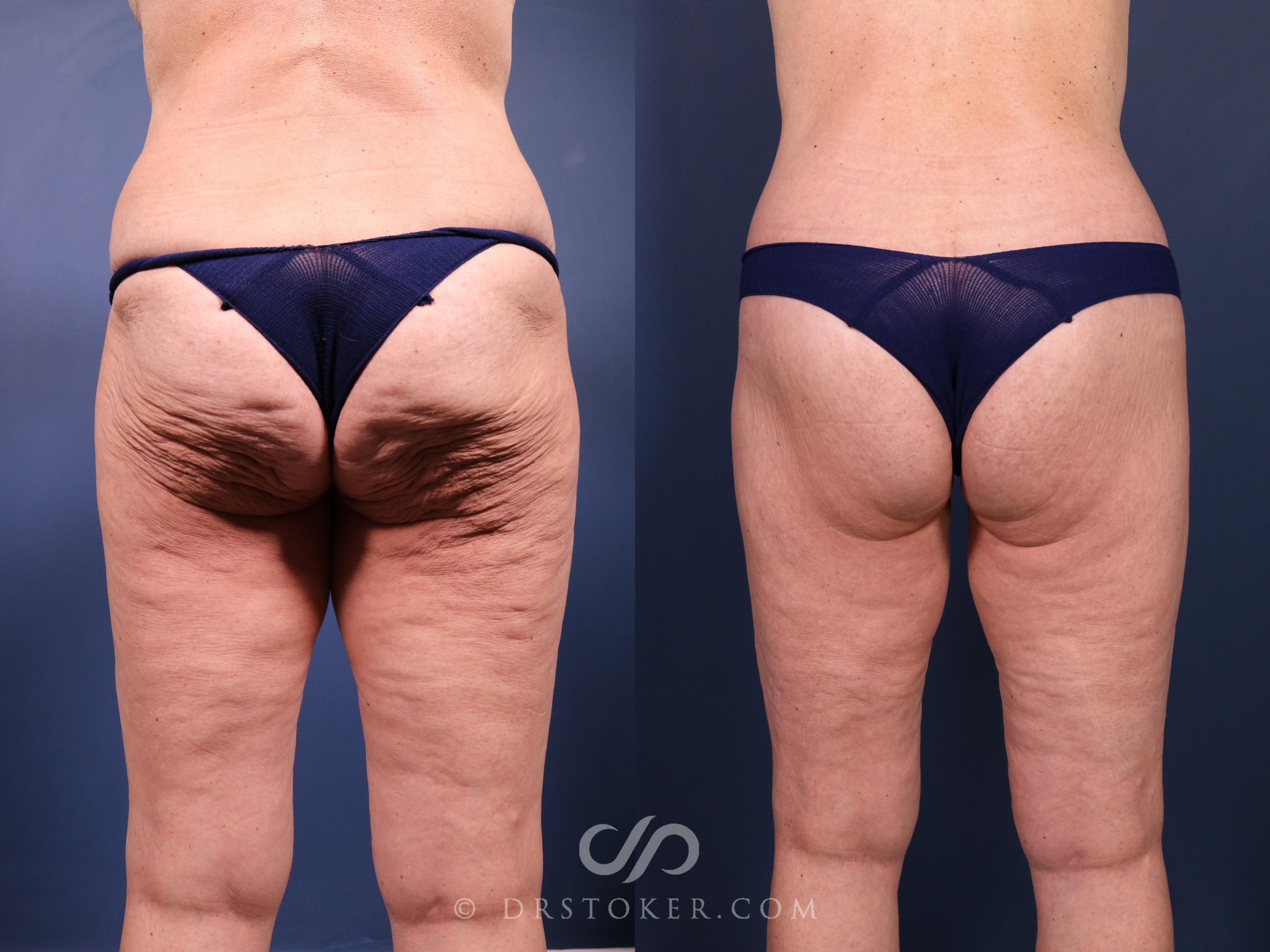 Before & After Bikini Body Lift Case 2406 Back View in Los Angeles, CA