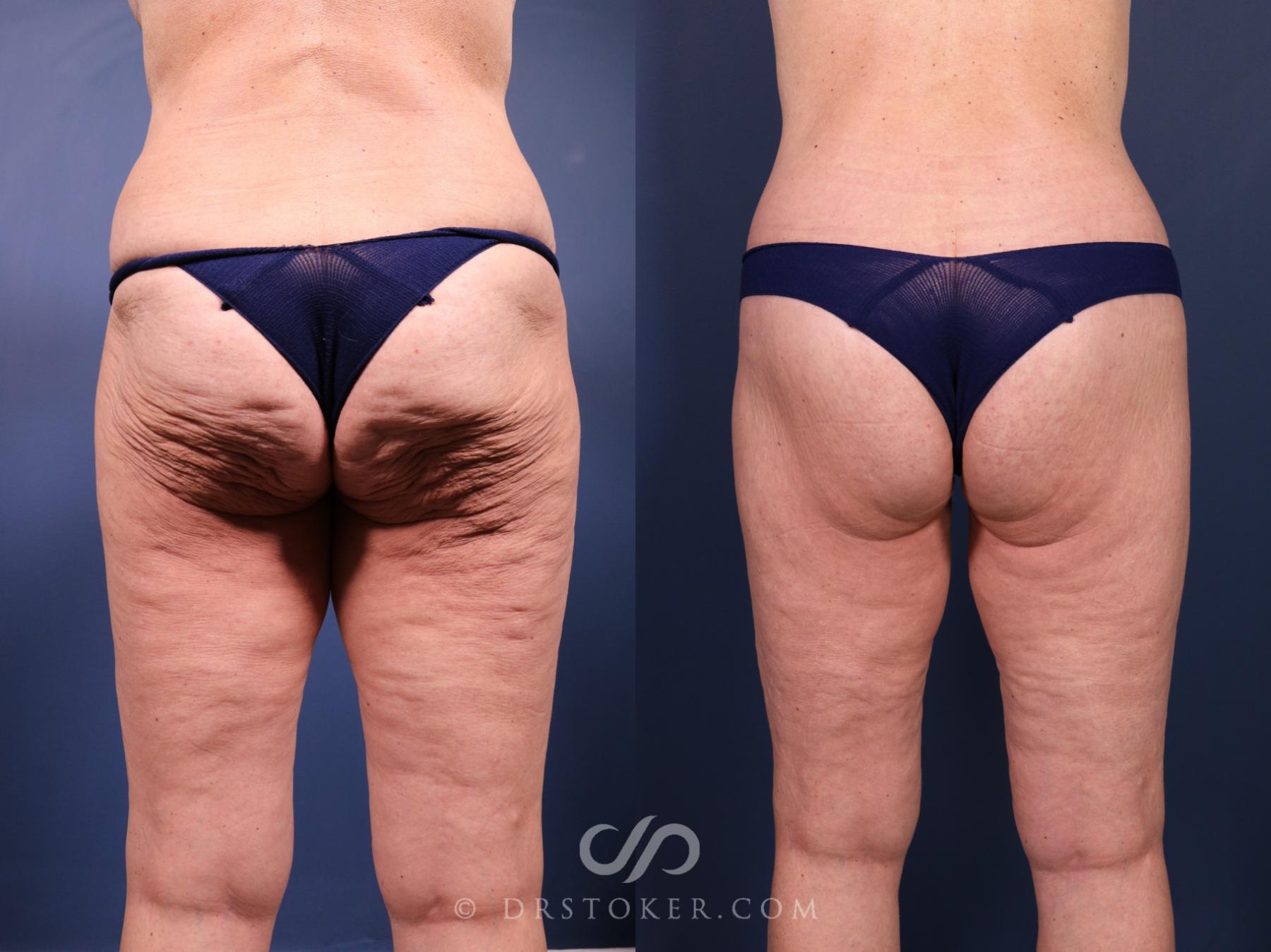 Before & After Bikini Body Lift Case 2406 Back View in Los Angeles, CA