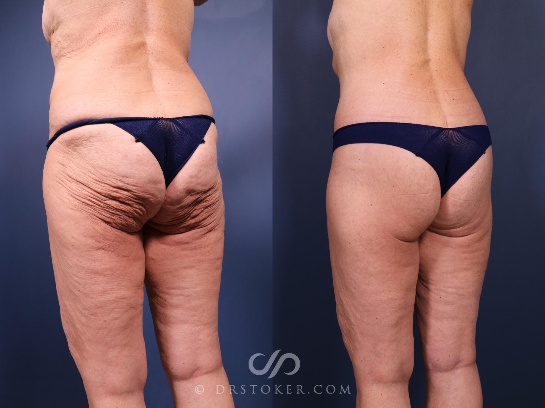 Before & After Bikini Body Lift Case 2406 Left Oblique View in Los Angeles, CA