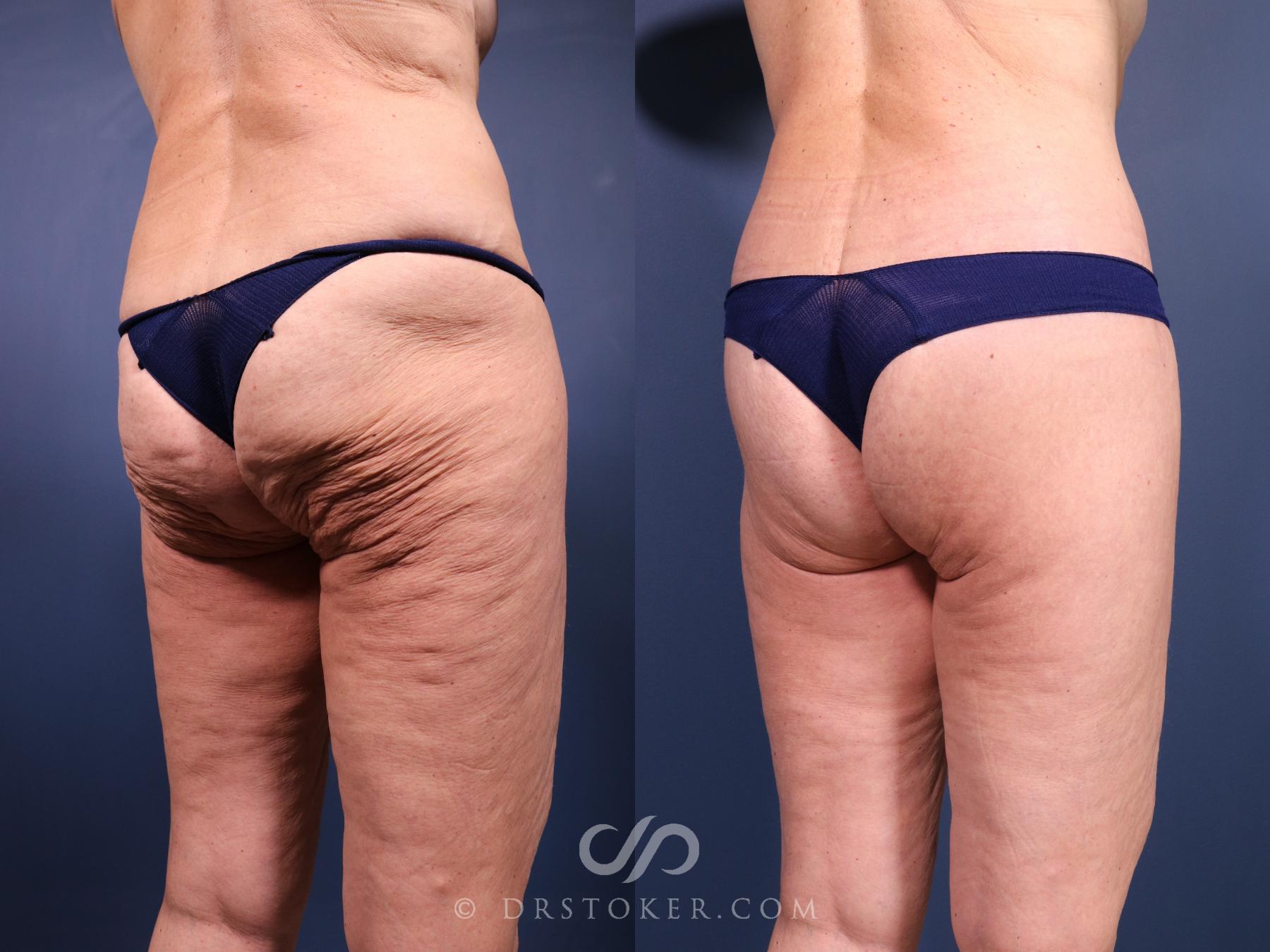 Before & After Bikini Body Lift Case 2406 Right Oblique View in Los Angeles, CA