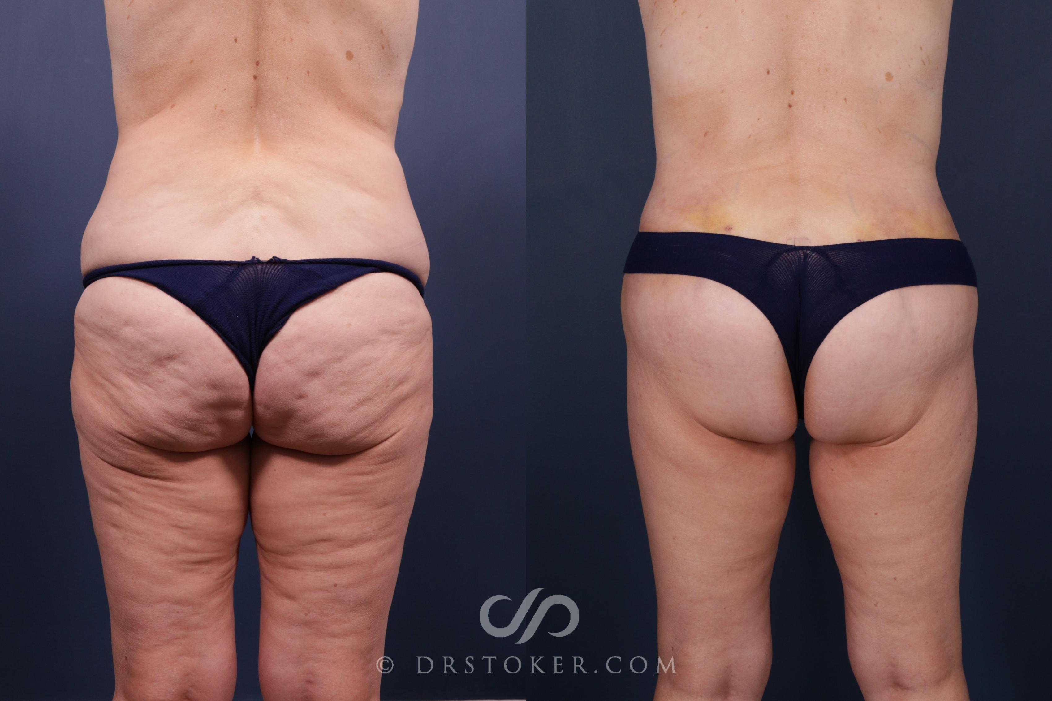 Before & After Bikini Body Lift Case 2407 Back View in Los Angeles, CA
