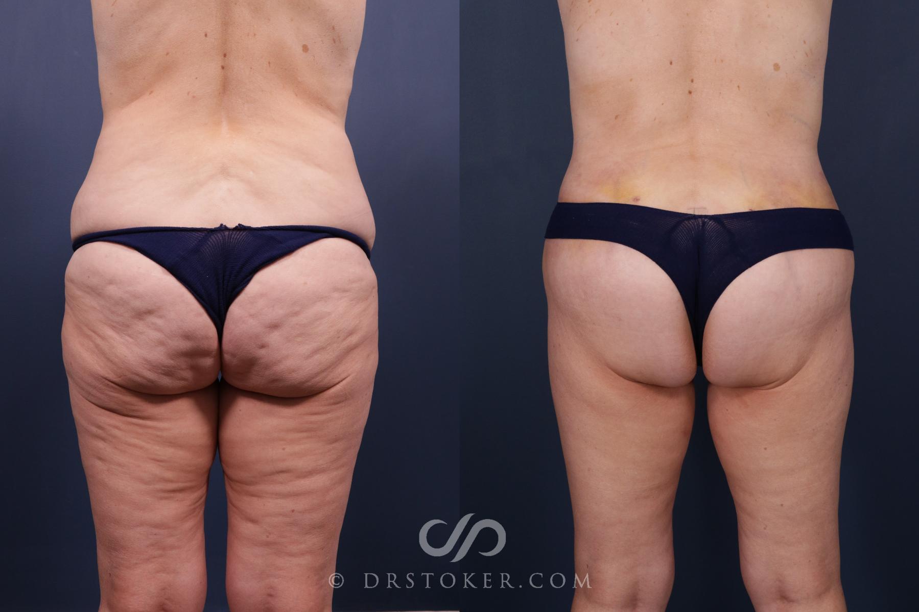 Before & After Bikini Body Lift Case 2407 Back View in Los Angeles, CA