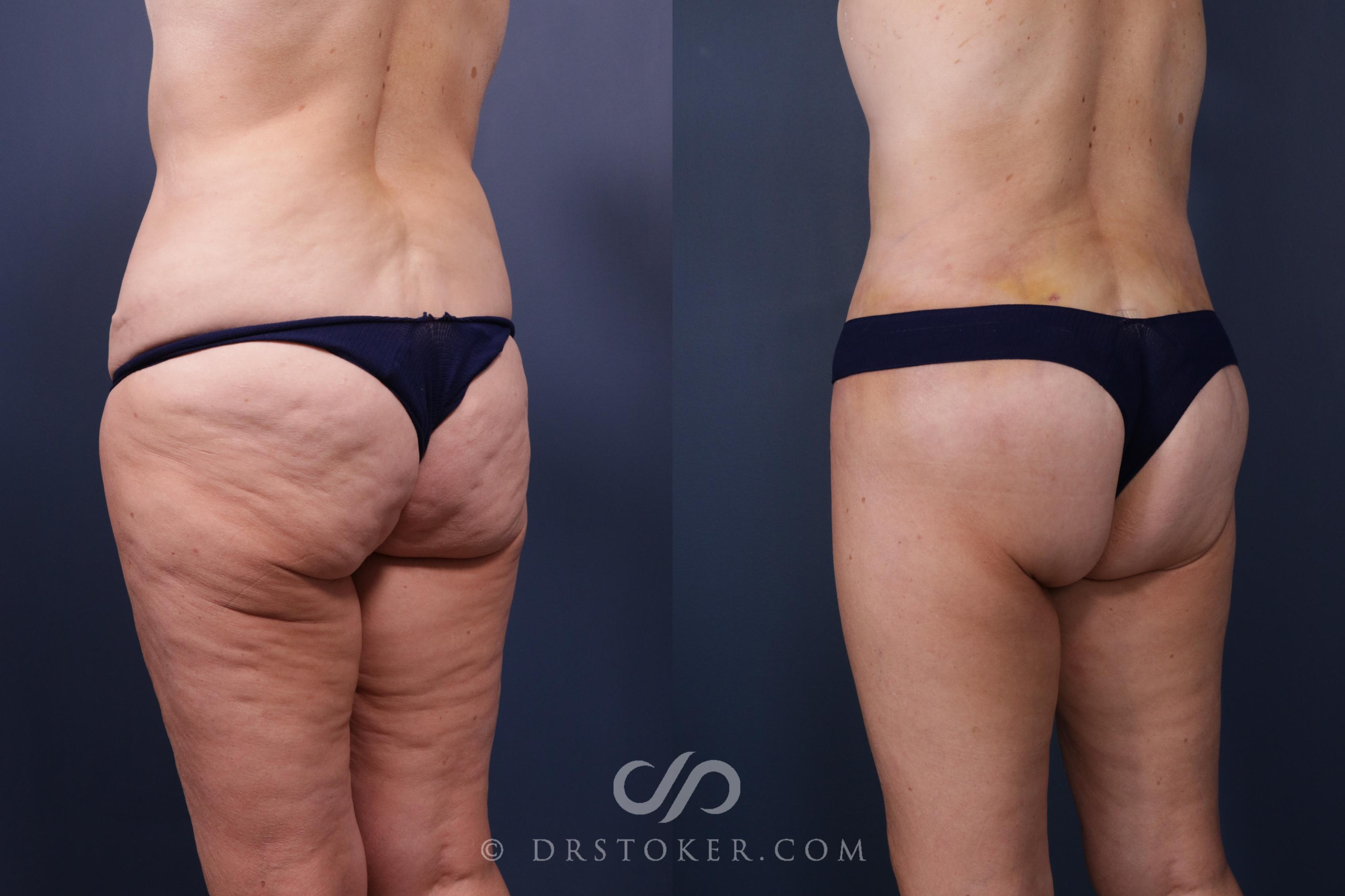 Before & After Bikini Body Lift Case 2407 Left Oblique View in Los Angeles, CA