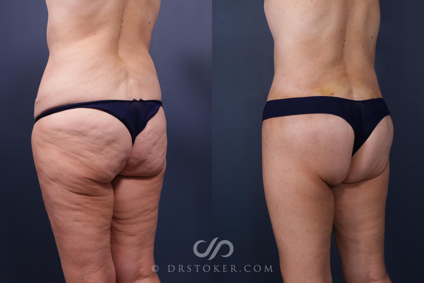 Before & After Bikini Body Lift Case 2407 Left Oblique View in Los Angeles, CA