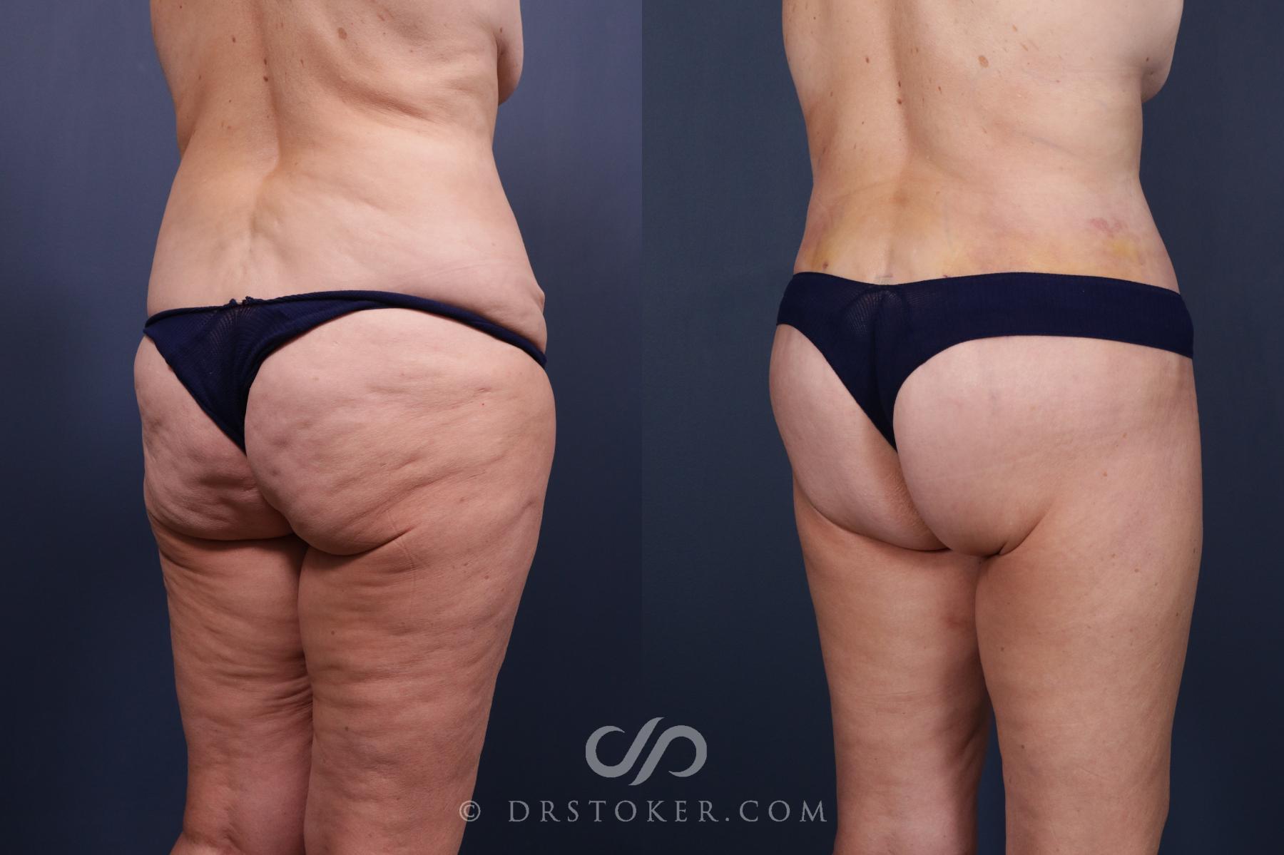 Before & After Bikini Body Lift Case 2407 Right Oblique View in Los Angeles, CA