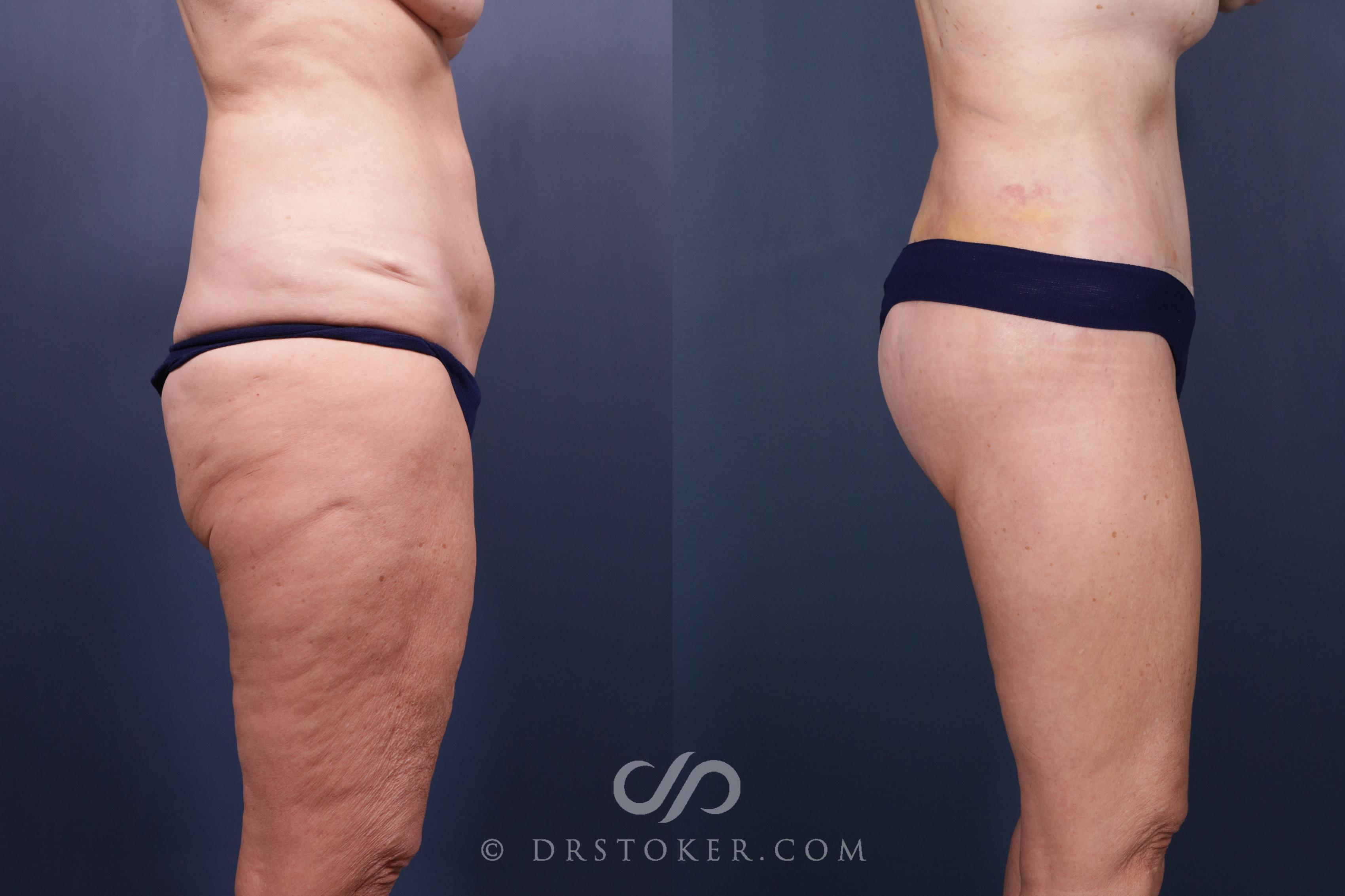 Before & After Bikini Body Lift Case 2407 Right Side View in Los Angeles, CA
