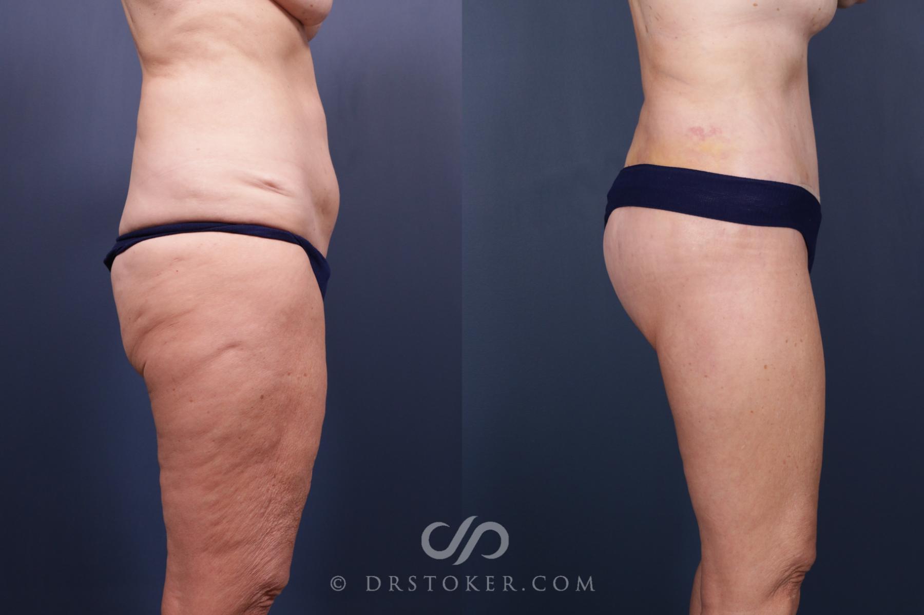 Before & After Bikini Body Lift Case 2407 Right Side View in Los Angeles, CA