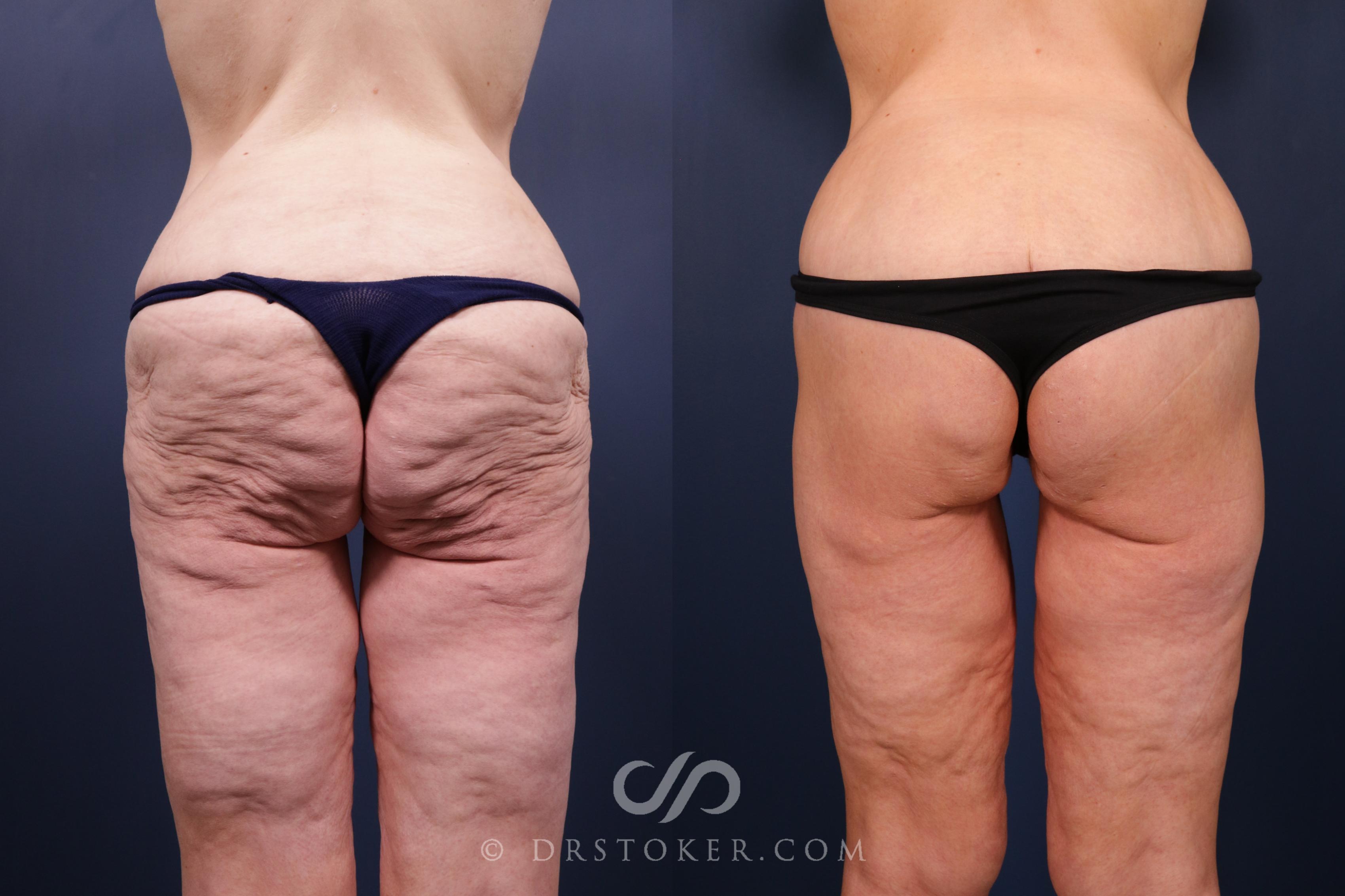 Before & After Bikini Body Lift Case 2408 Back View in Los Angeles, CA