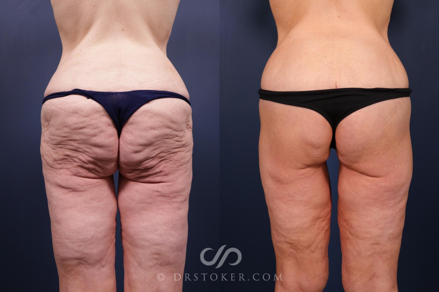Before & After Bikini Body Lift Case 2408 Back View in Los Angeles, CA