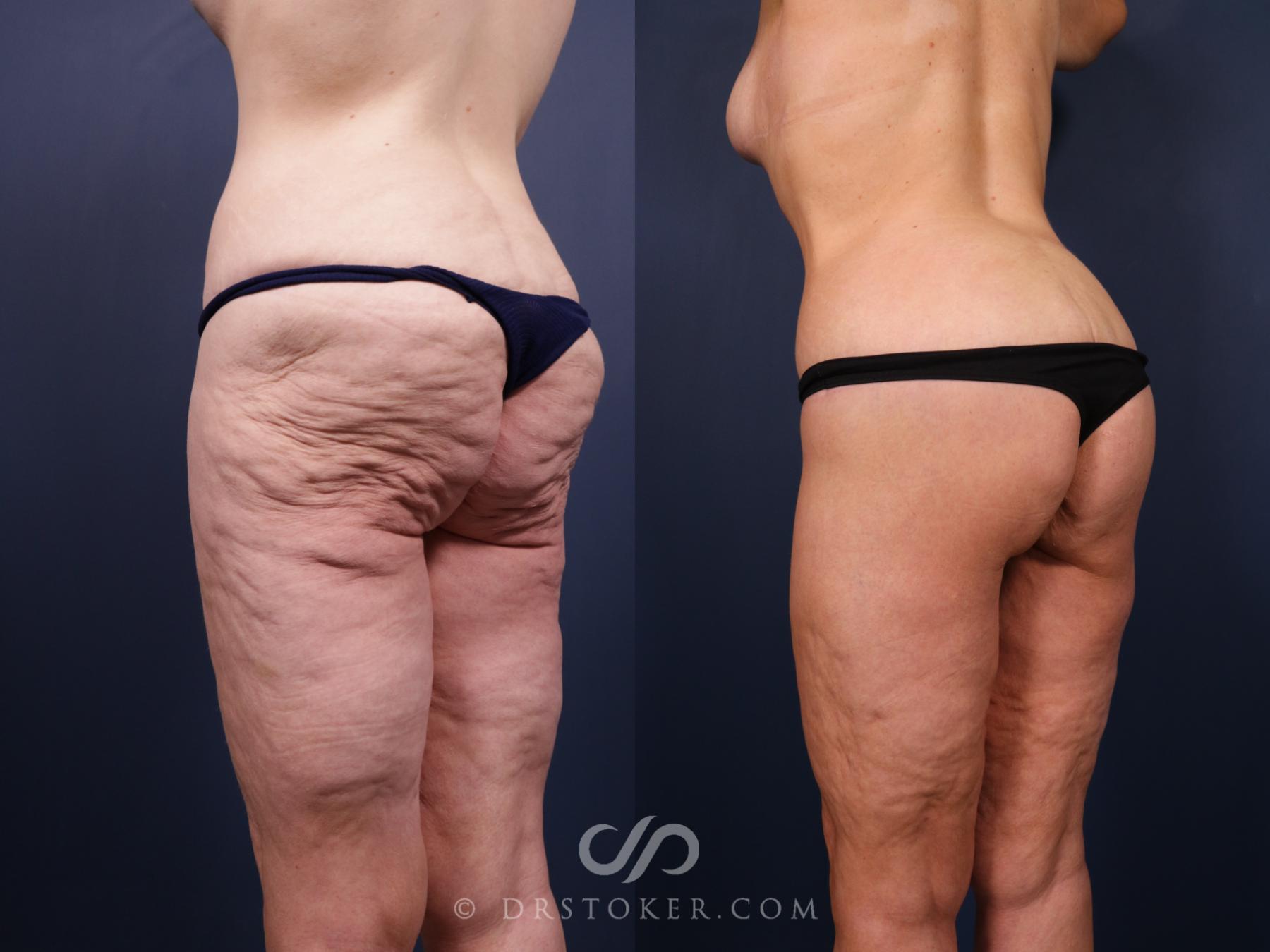 Before & After Bikini Body Lift Case 2408 Left Oblique View in Los Angeles, CA