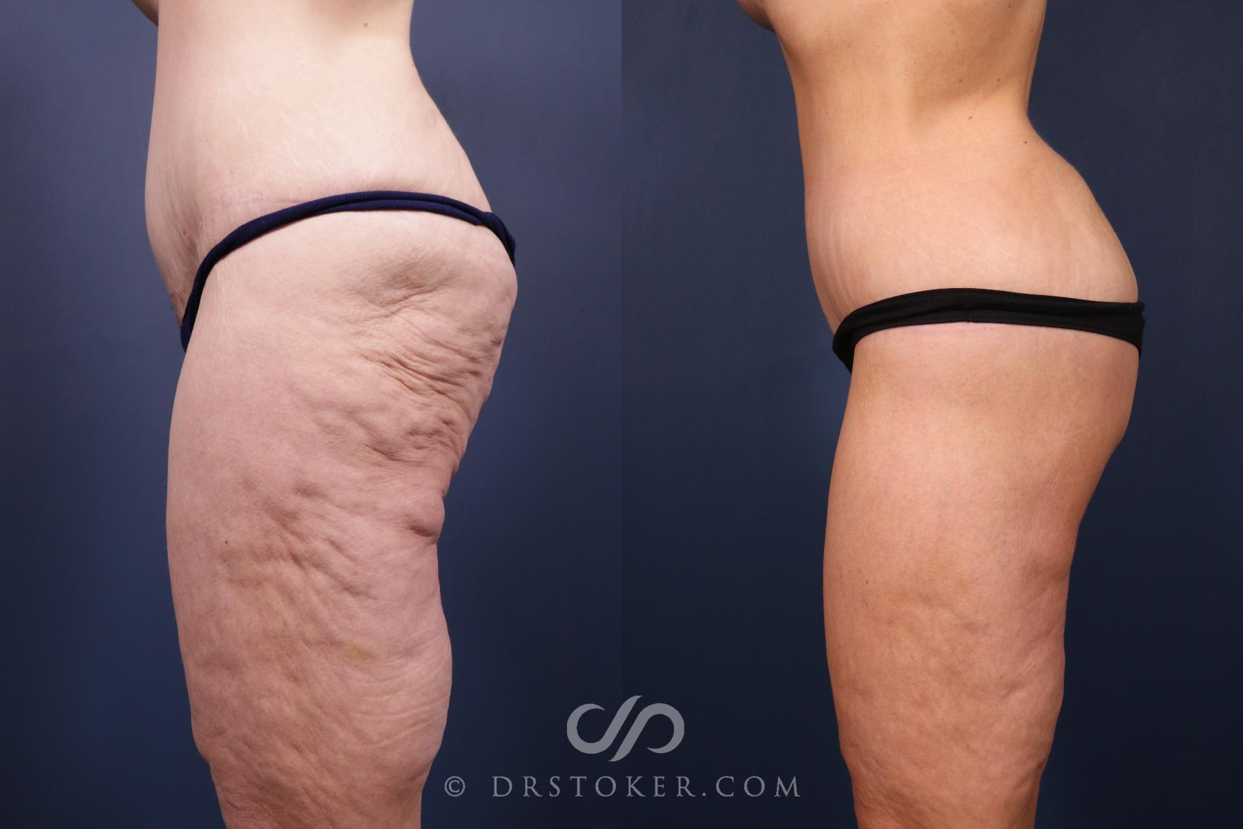 Before & After Bikini Body Lift Case 2408 Left Side View in Los Angeles, CA