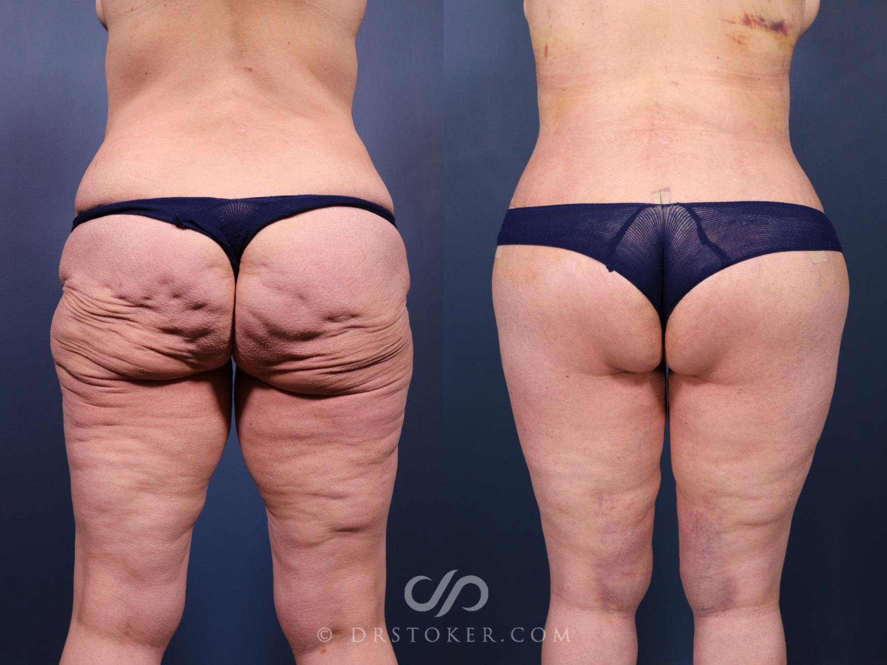 Before & After Bikini Body Lift Case 2409 Back View in Los Angeles, CA