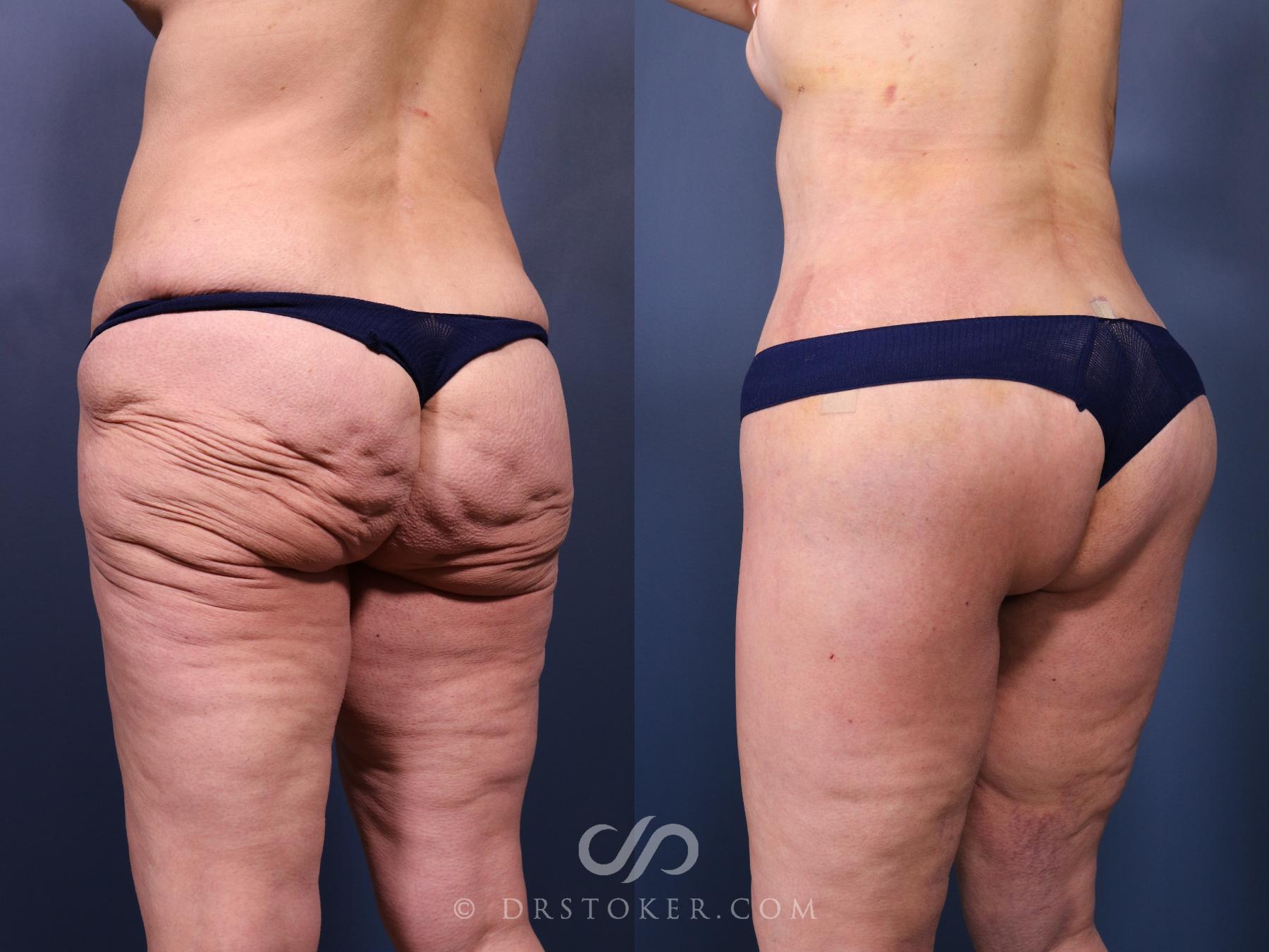 Before & After Bikini Body Lift Case 2409 Left Oblique View in Los Angeles, CA