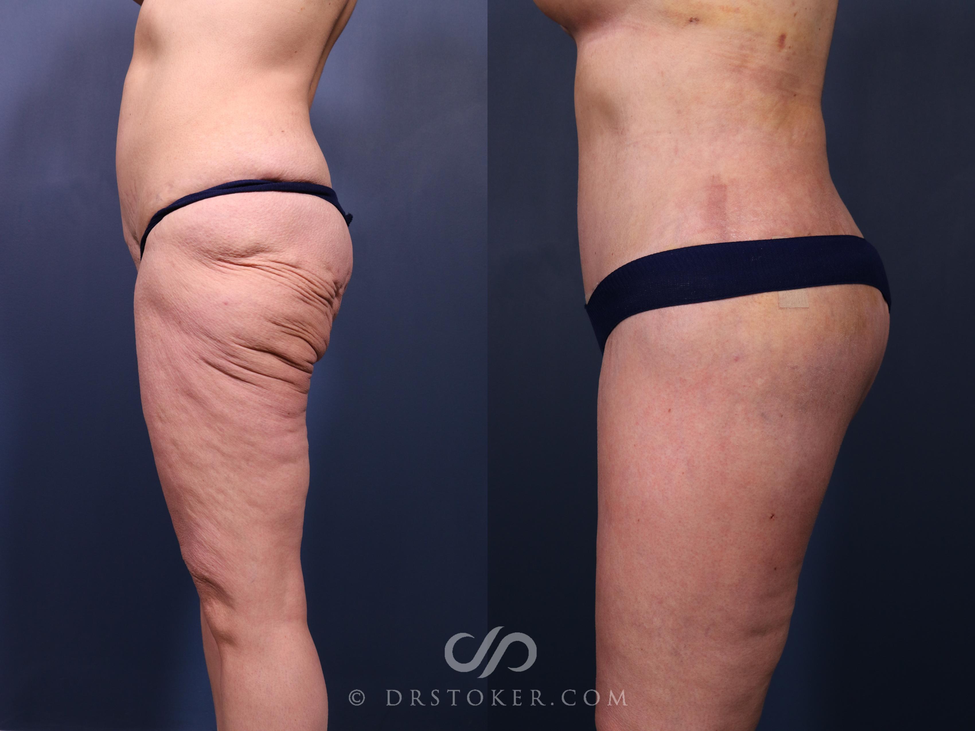Before & After Bikini Body Lift Case 2409 Left Side View in Los Angeles, CA
