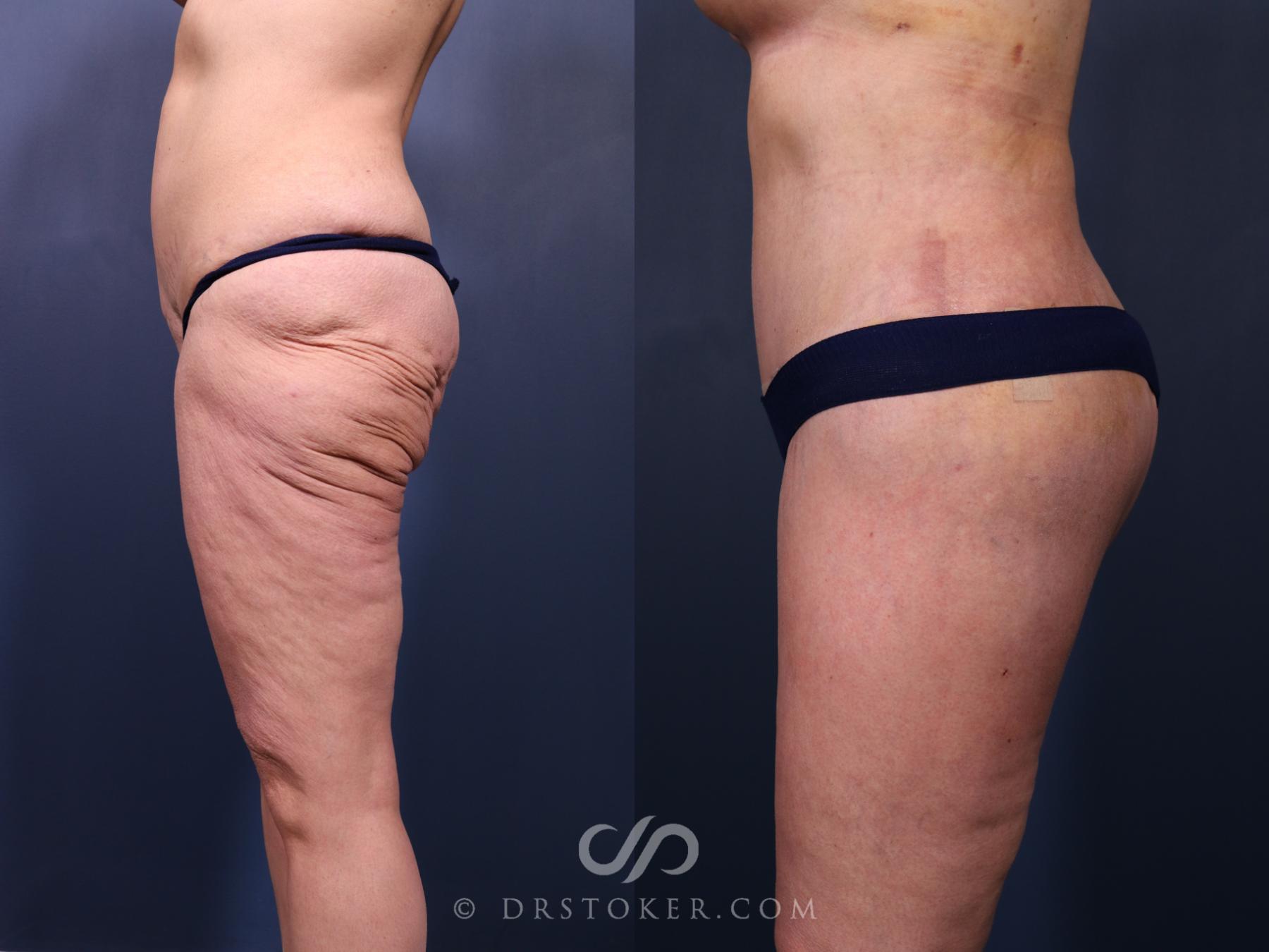 Before & After Bikini Body Lift Case 2409 Left Side View in Los Angeles, CA