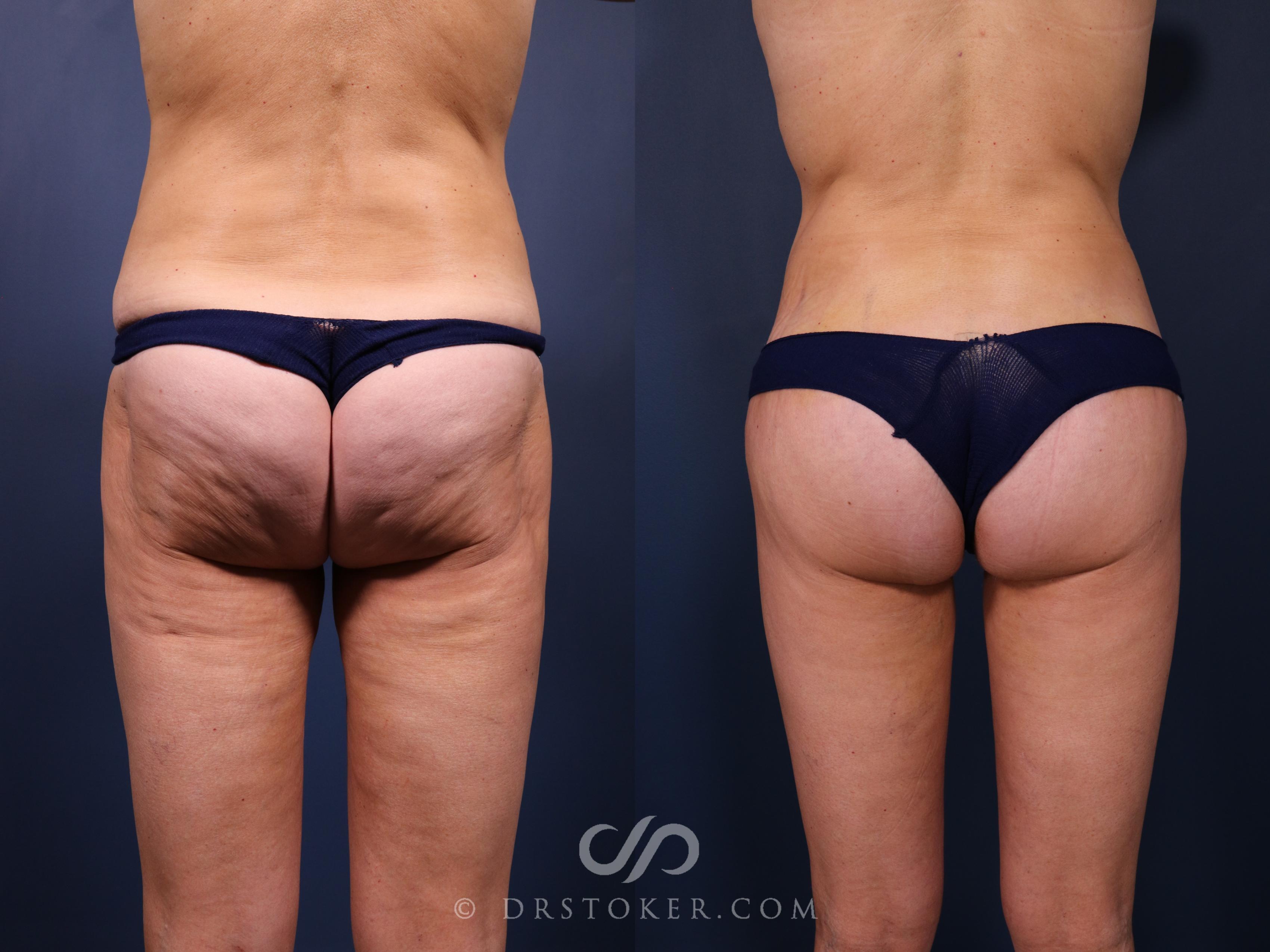 Before & After Bikini Body Lift Case 2410 Back View in Los Angeles, CA
