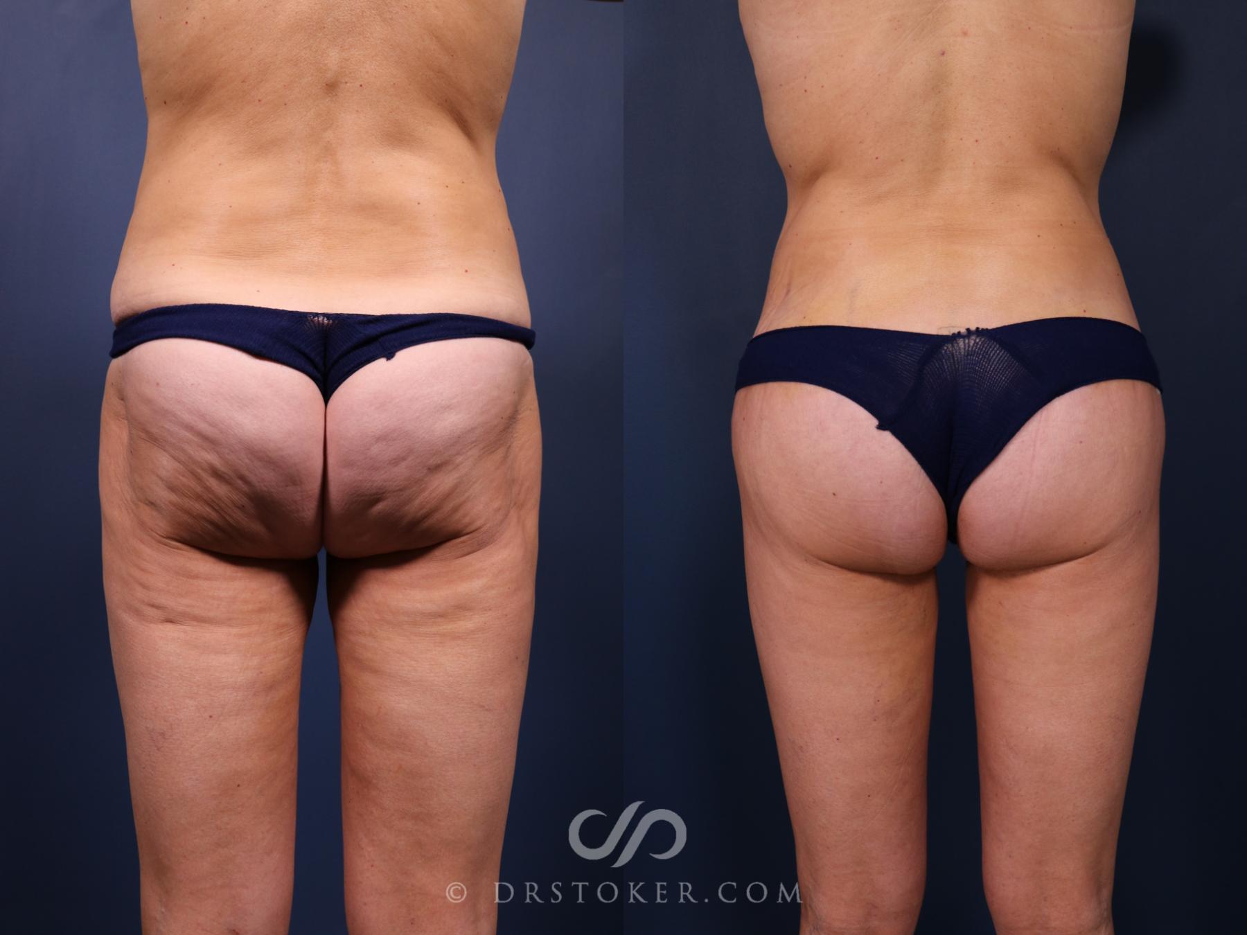 Before & After Bikini Body Lift Case 2410 Back View in Los Angeles, CA