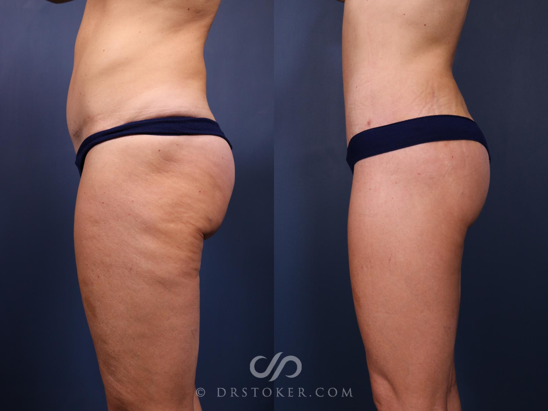 Before & After Bikini Body Lift Case 2410 Left Side View in Los Angeles, CA
