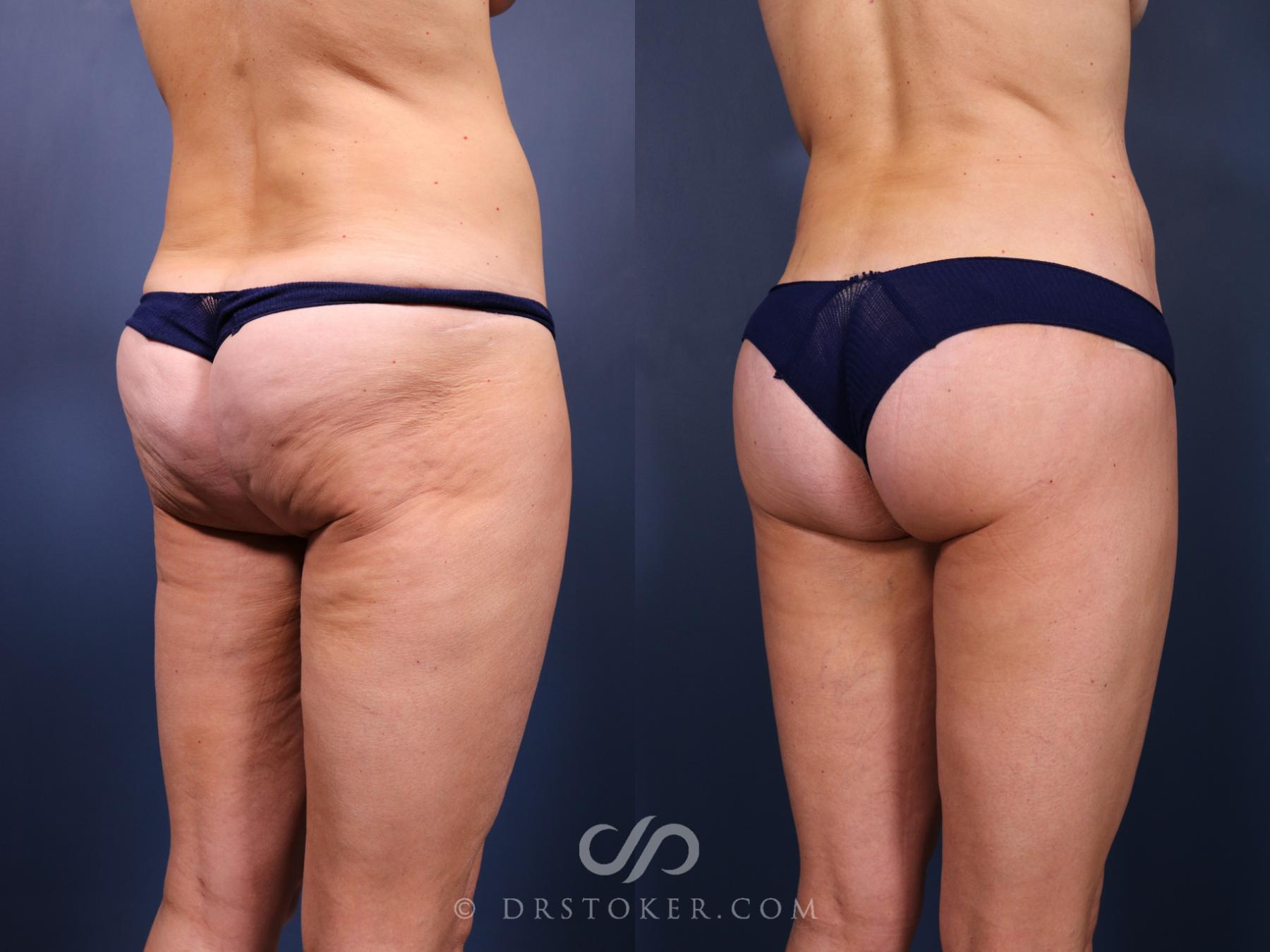 Before & After Bikini Body Lift Case 2410 Right Oblique View in Los Angeles, CA