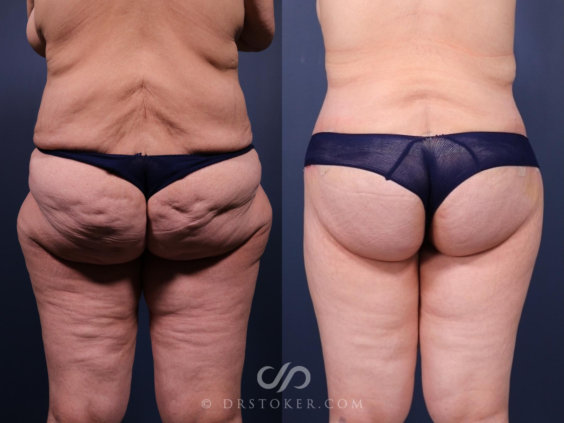 Before & After Bikini Body Lift Case 2411 Back View in Los Angeles, CA