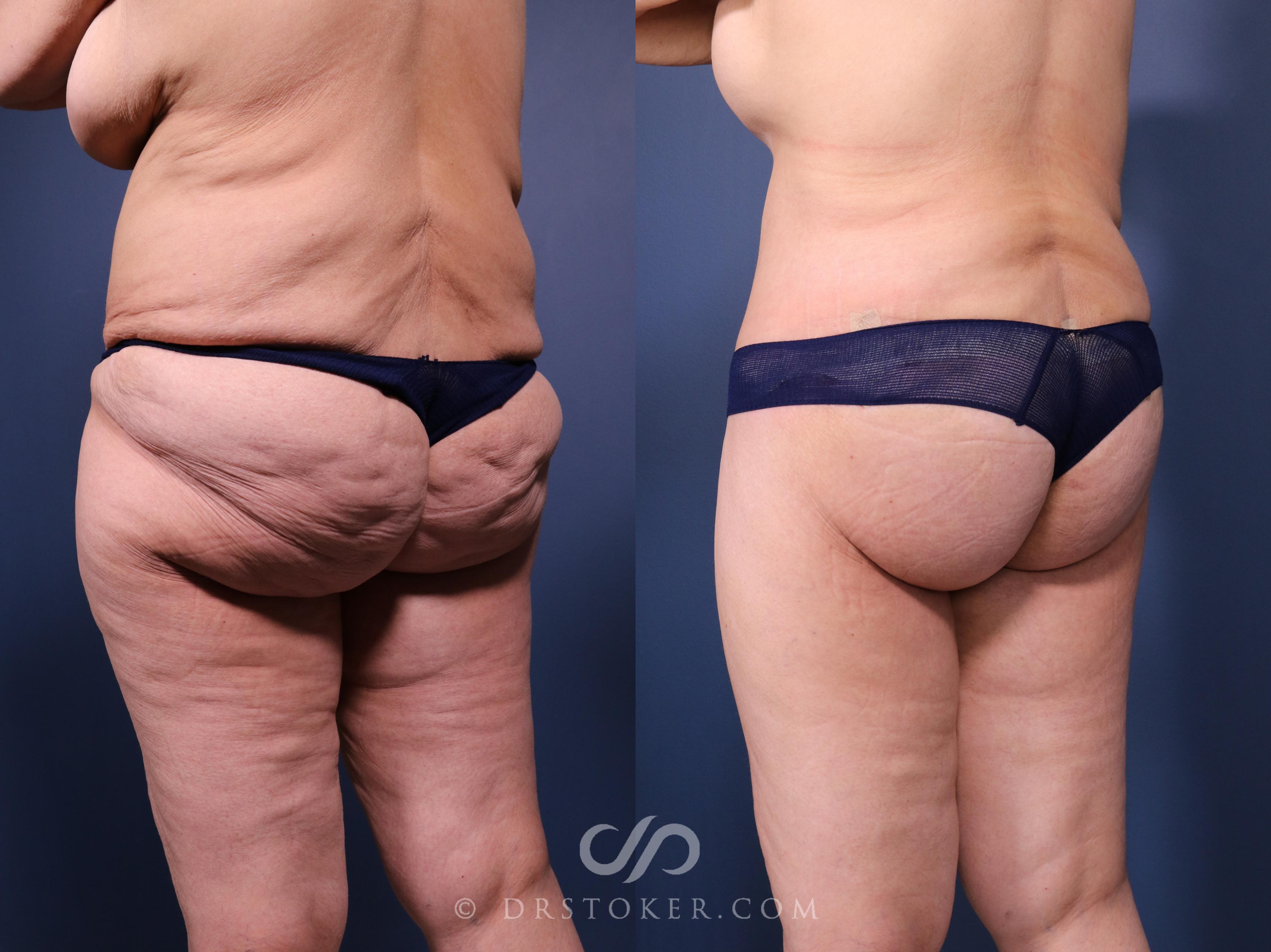 Before & After Bikini Body Lift Case 2411 Left Oblique View in Los Angeles, CA