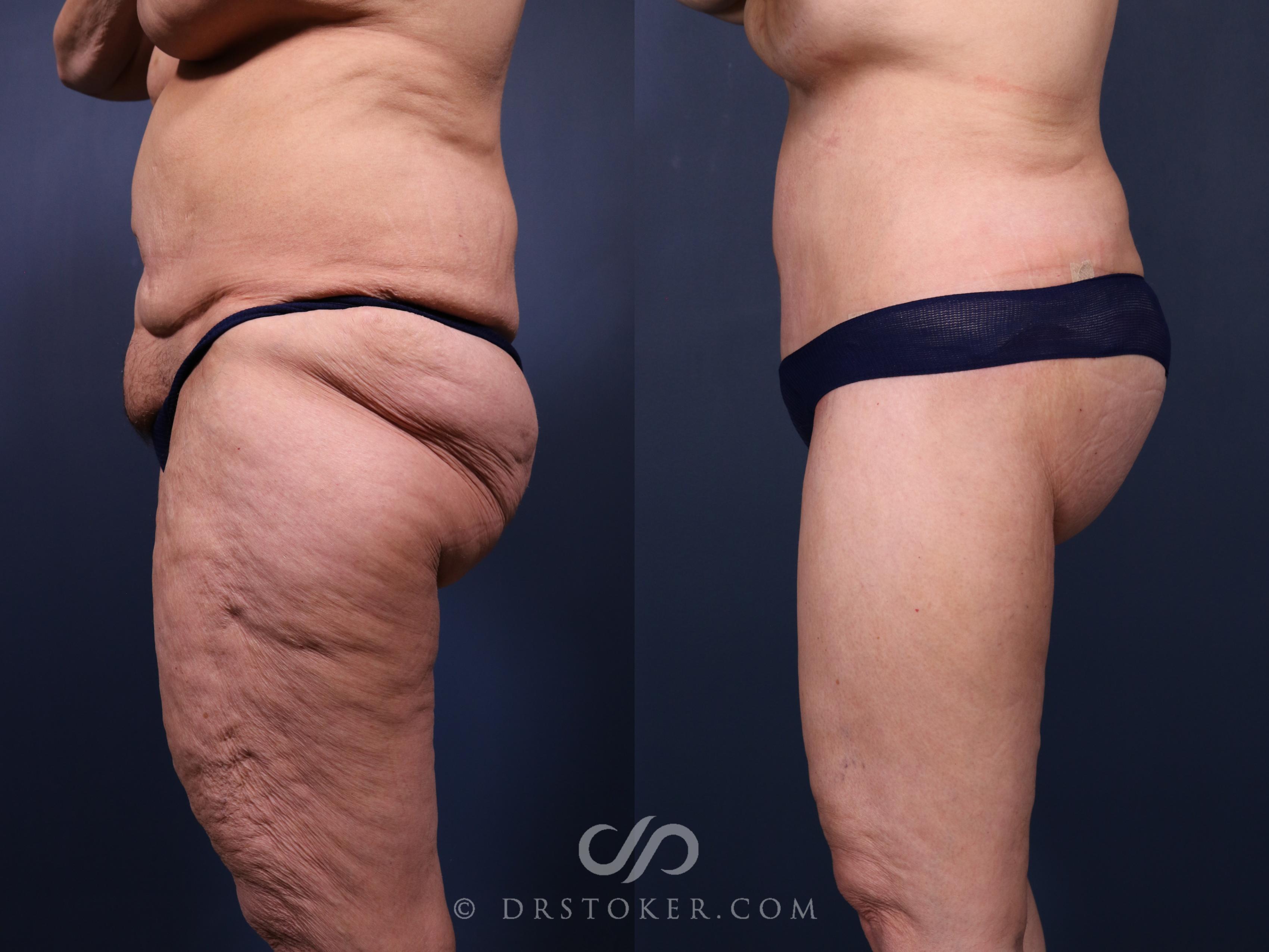 Before & After Bikini Body Lift Case 2411 Left Side View in Los Angeles, CA