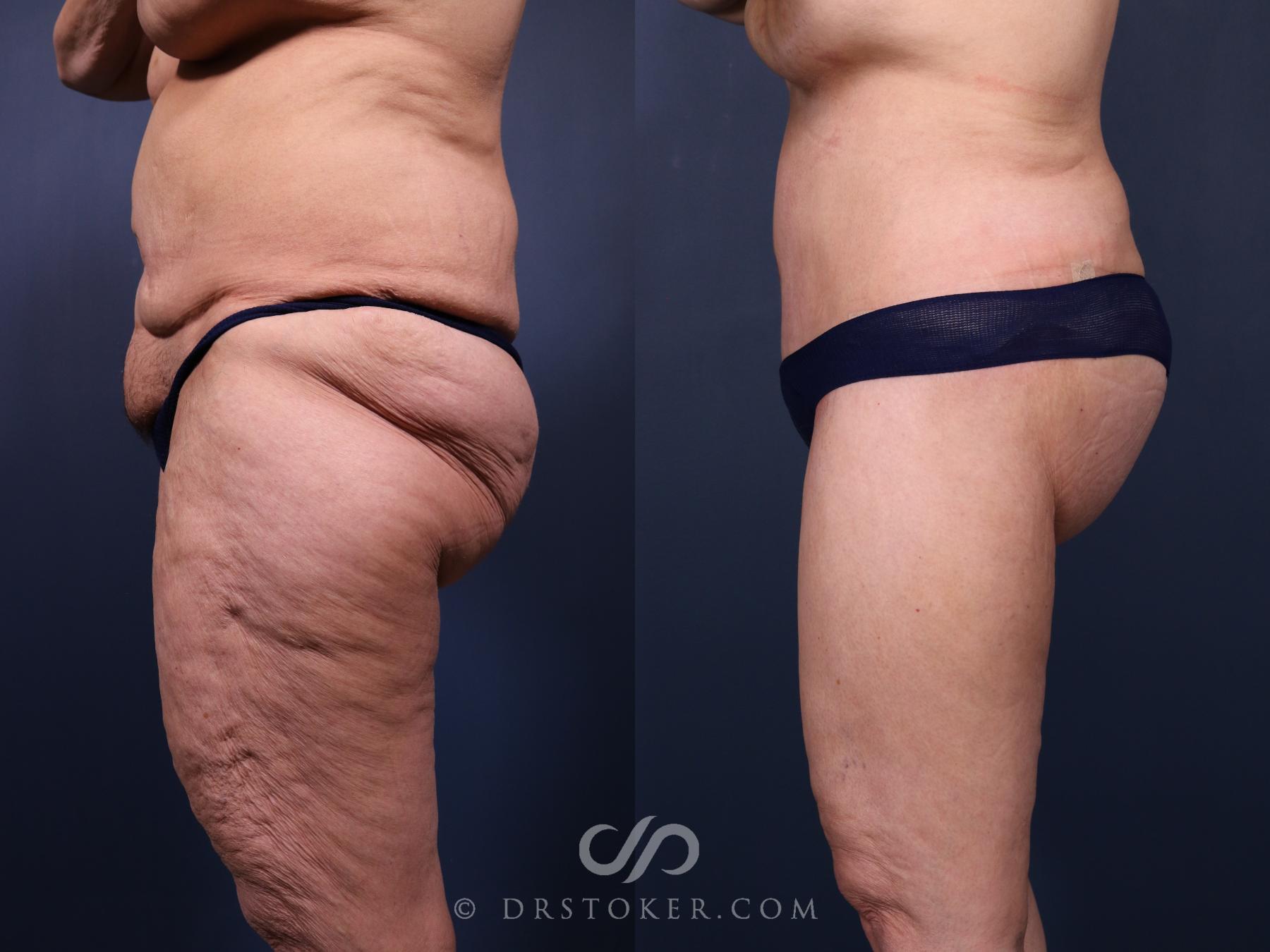 Before & After Bikini Body Lift Case 2411 Left Side View in Los Angeles, CA