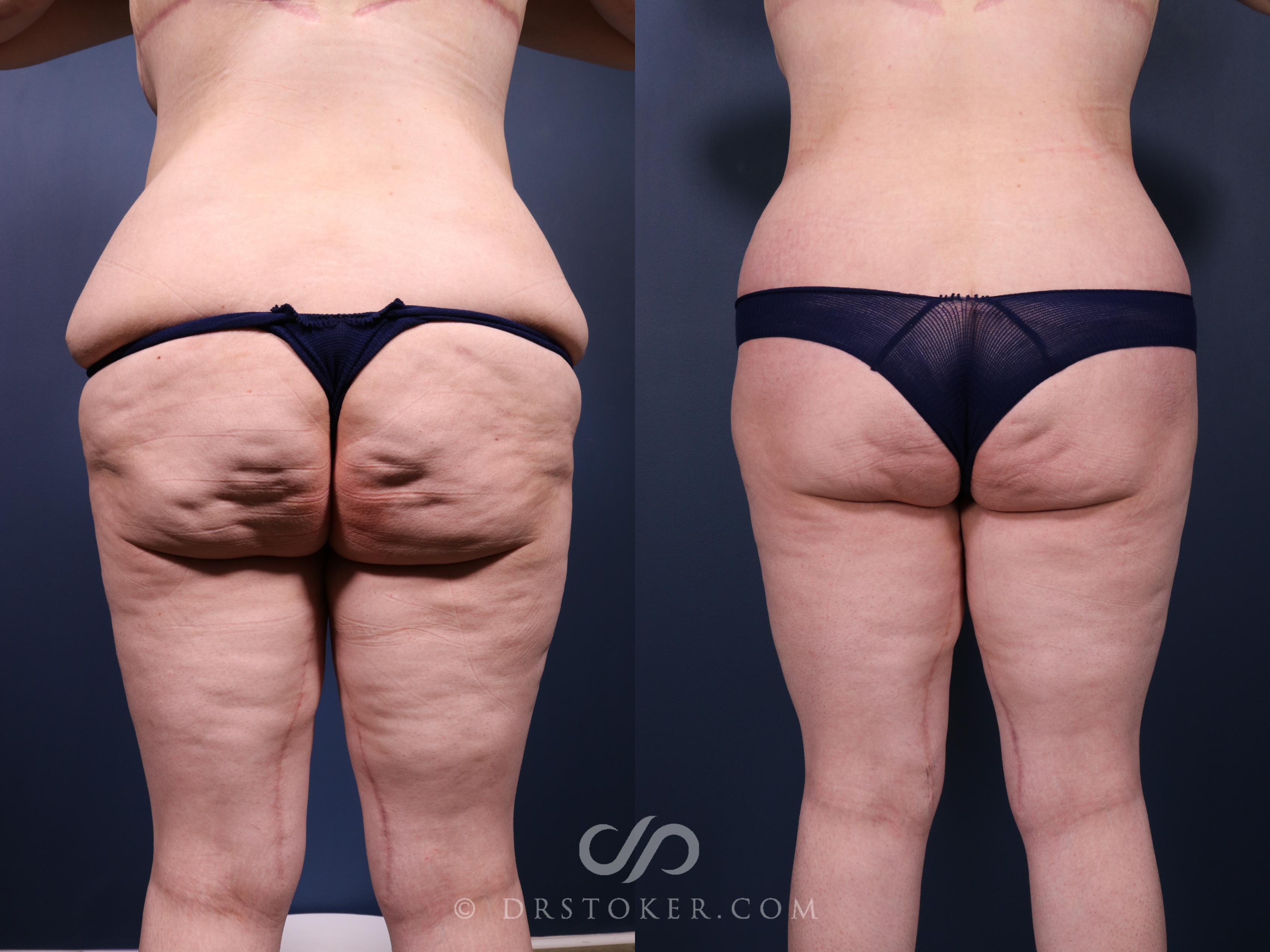 Before & After Bikini Body Lift Case 2412 Back View in Los Angeles, CA