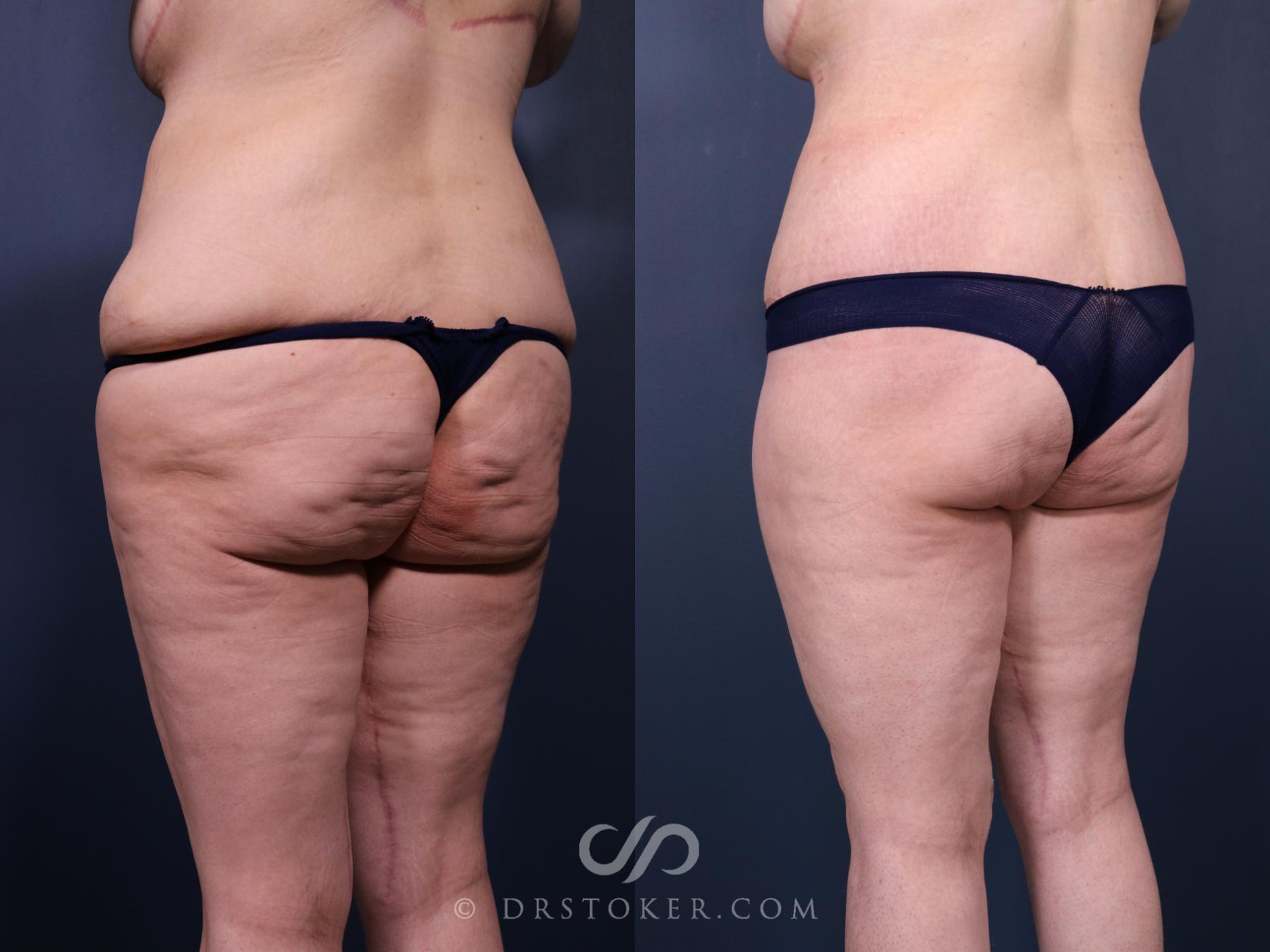 Before & After Bikini Body Lift Case 2412 Left Oblique View in Los Angeles, CA