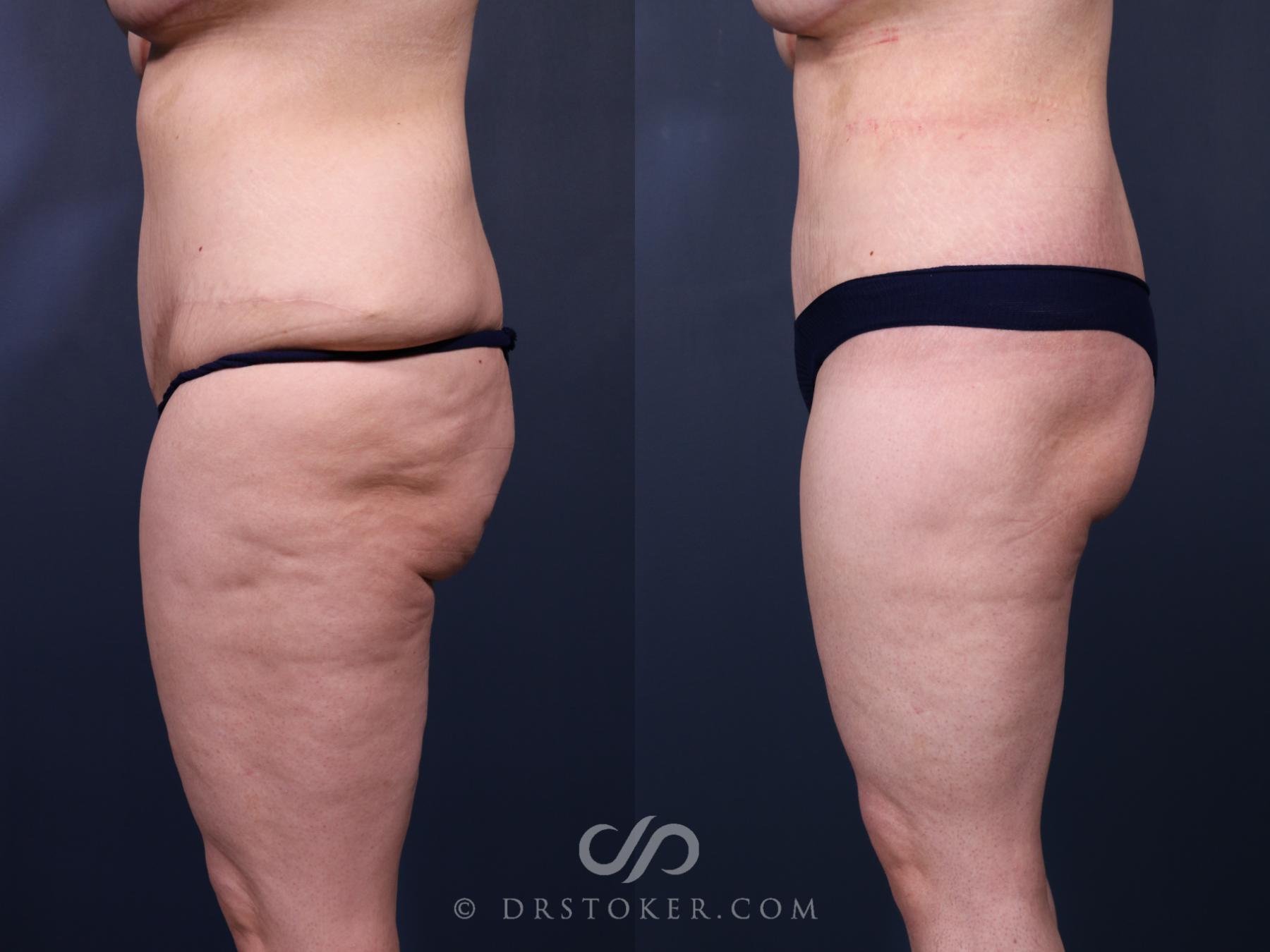 Before & After Bikini Body Lift Case 2412 Left Side View in Los Angeles, CA
