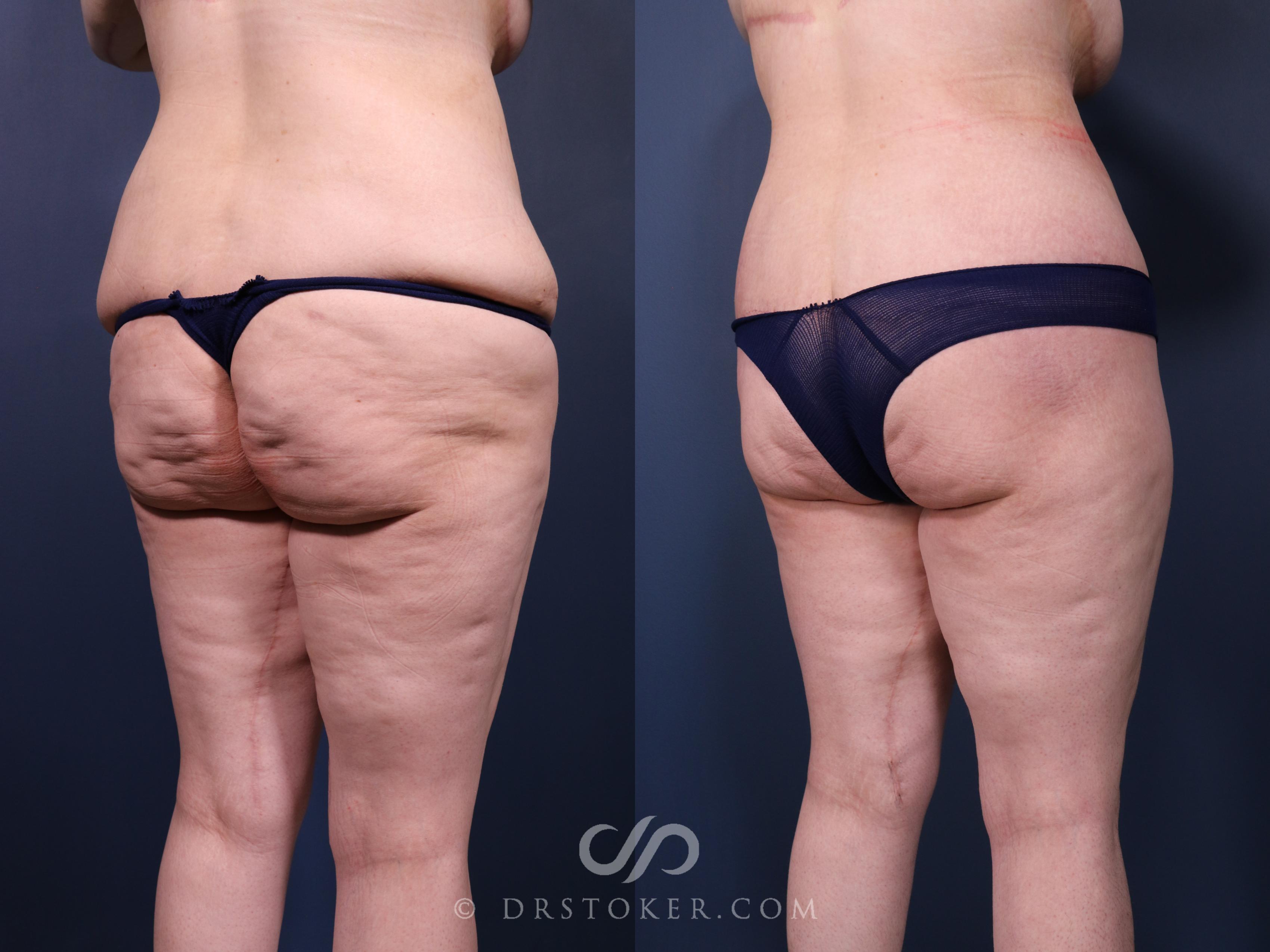 Before & After Bikini Body Lift Case 2412 Right Oblique View in Los Angeles, CA