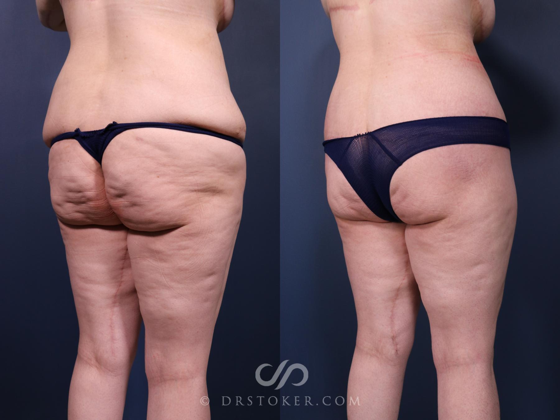 Before & After Bikini Body Lift Case 2412 Right Oblique View in Los Angeles, CA