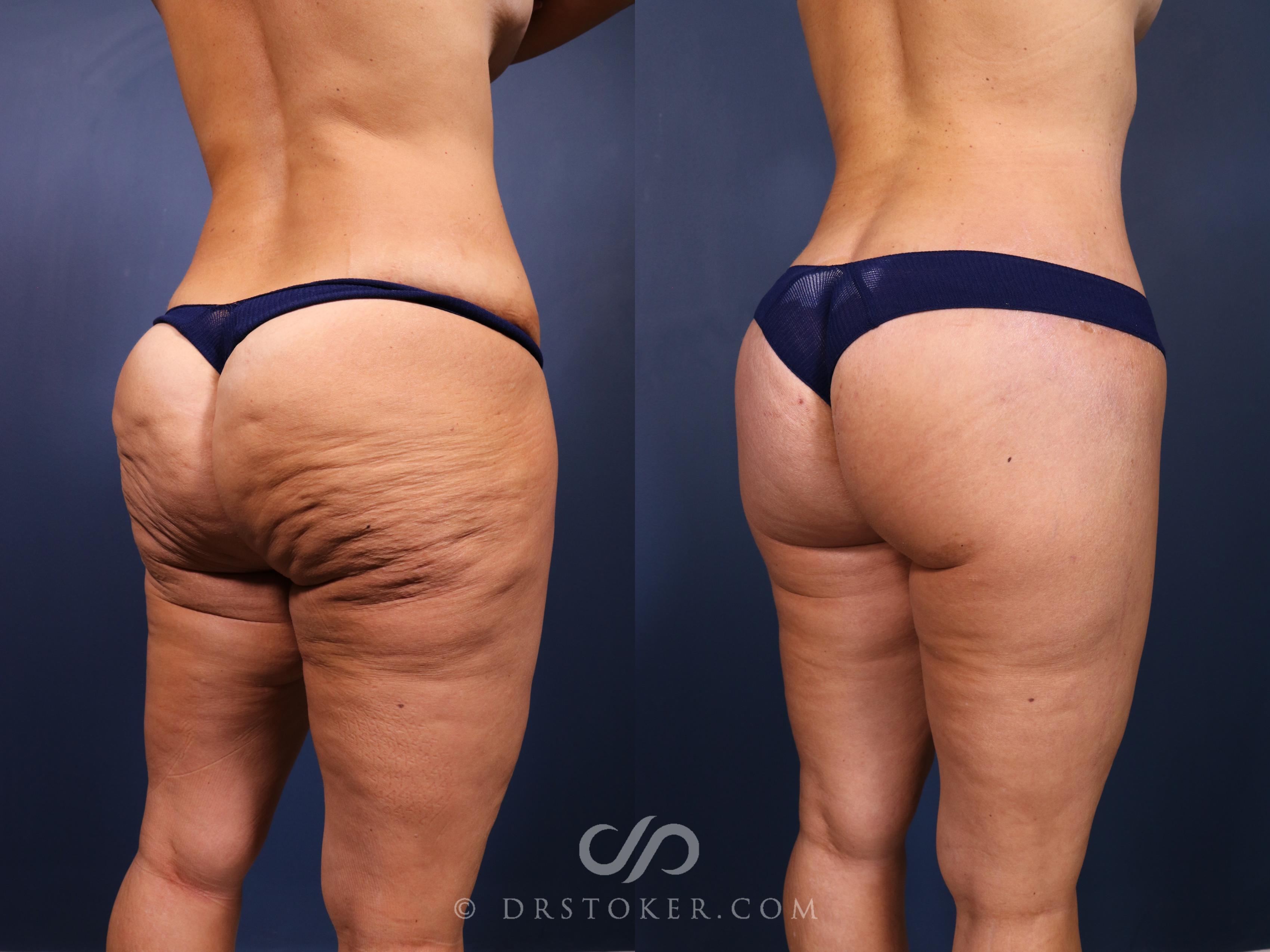 Before & After Buttock Lift (Excisional) Case 2413 Right Oblique View in Los Angeles, CA