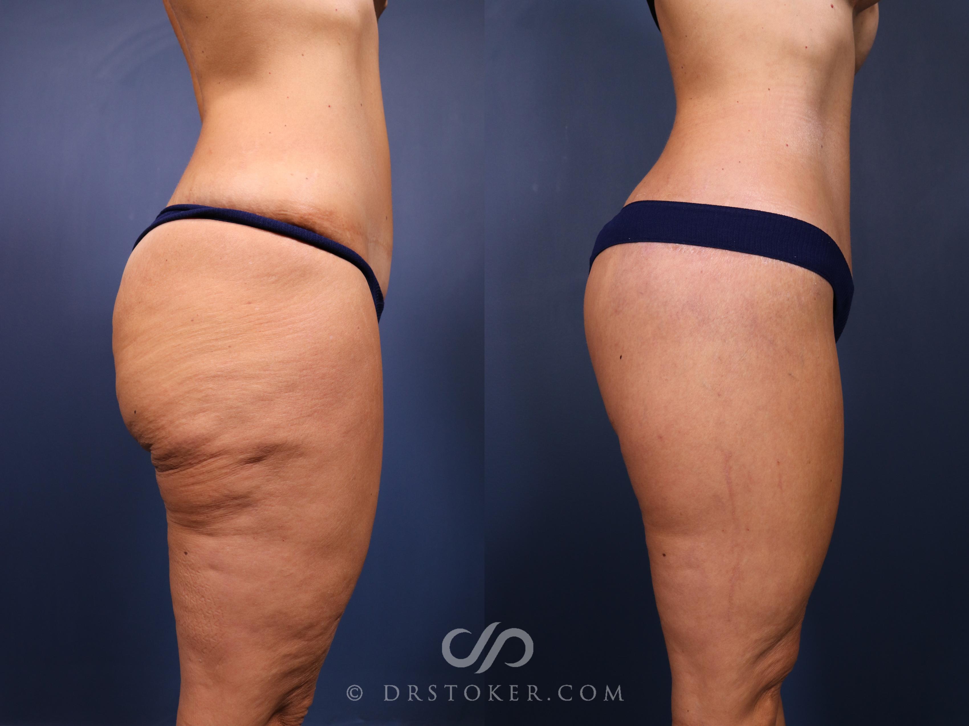 Before & After Buttock Lift (Excisional) Case 2413 Right Side View in Los Angeles, CA
