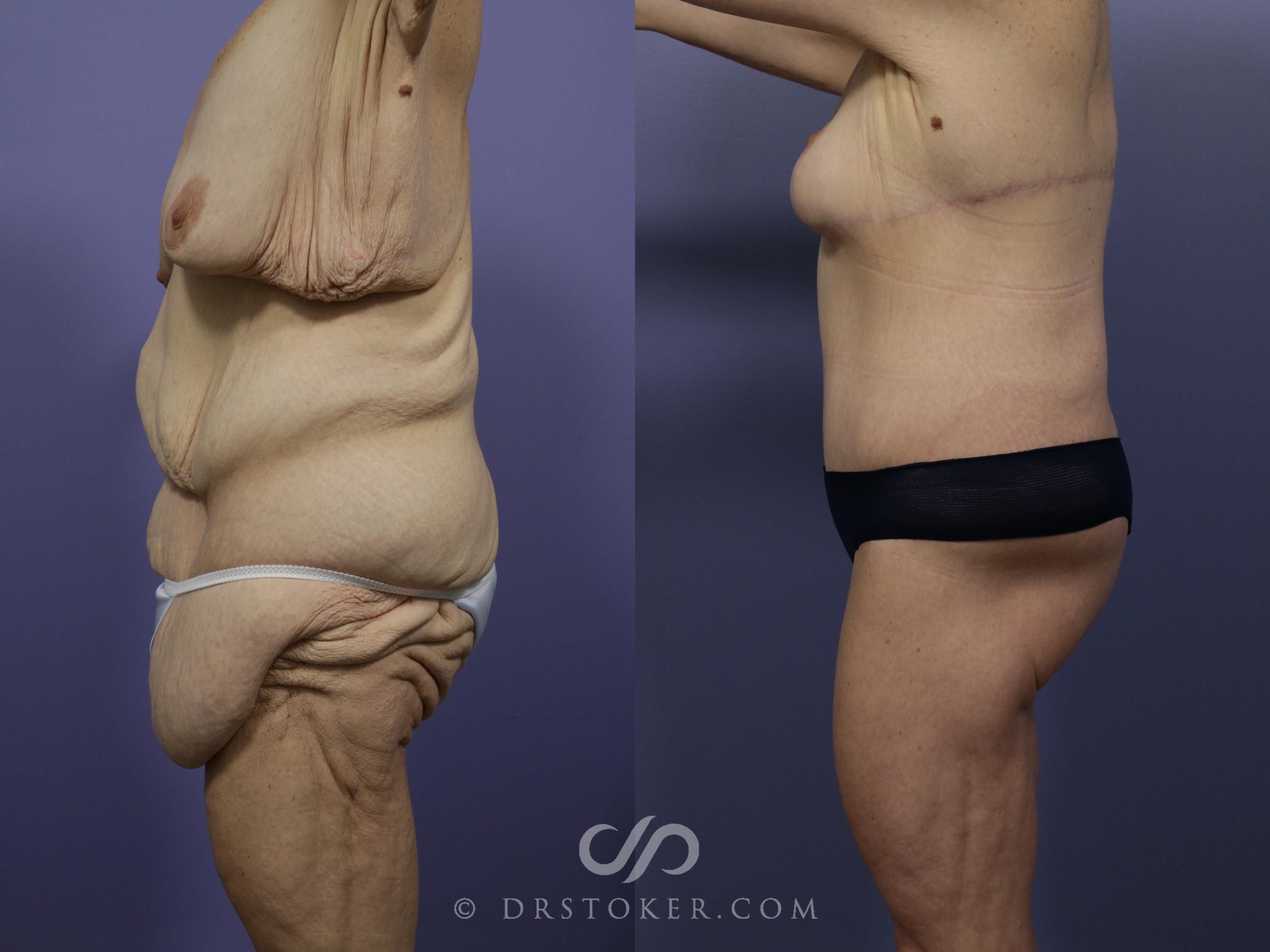 Before & After Body Lift Case 1001 View #2 View in Los Angeles, CA