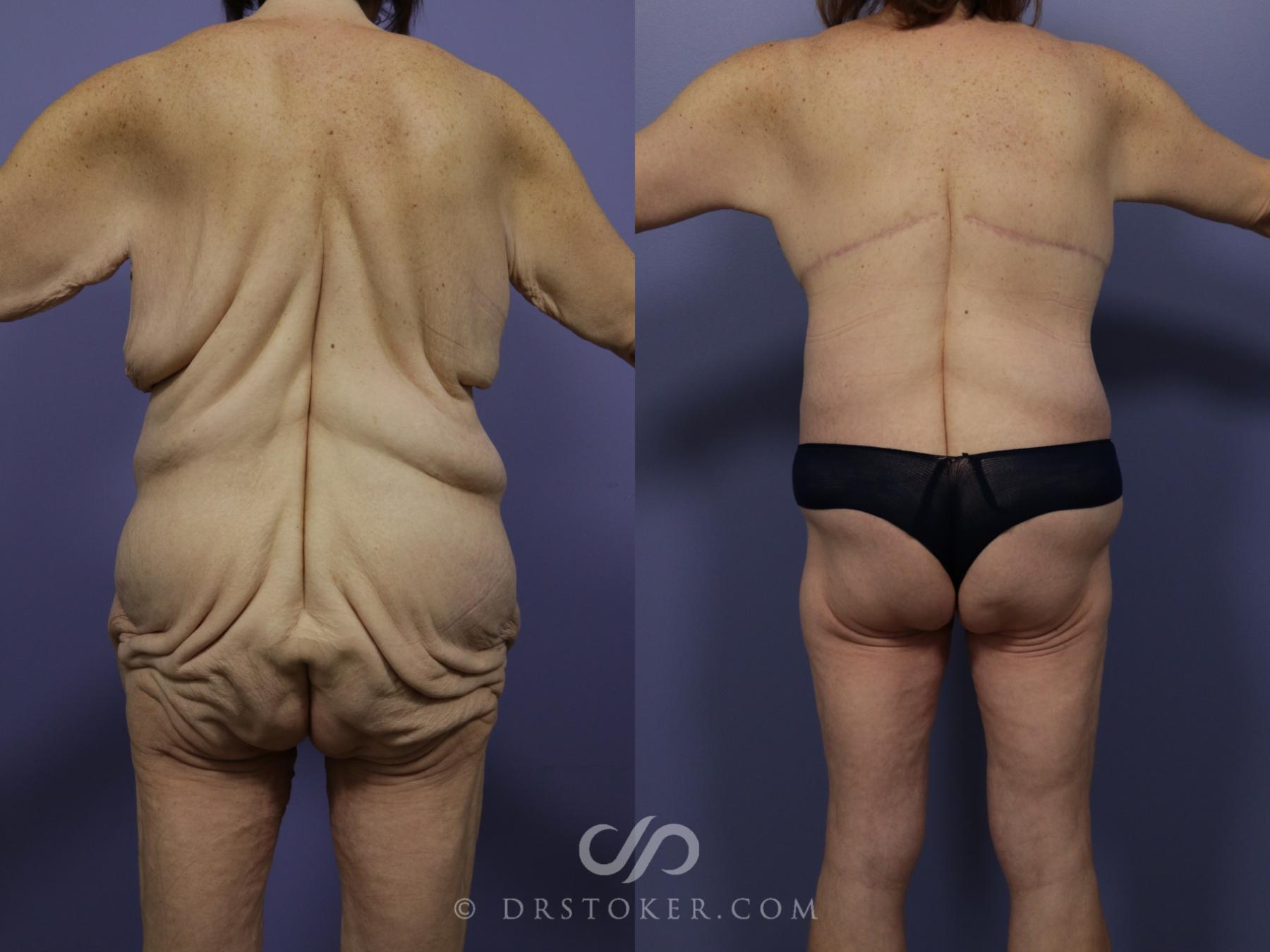Before & After Body Lift Case 1003 View #1 View in Los Angeles, CA