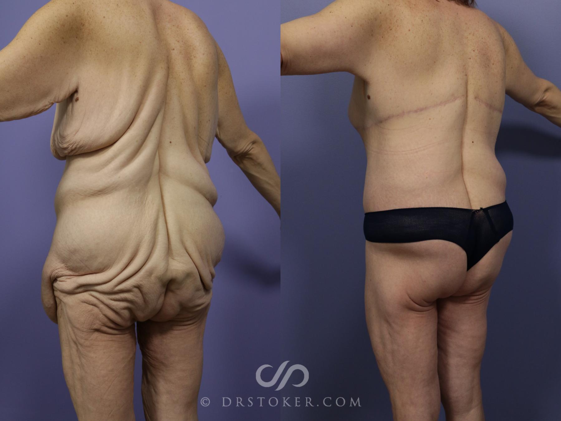 Before & After Body Lift Case 1003 View #2 View in Los Angeles, CA