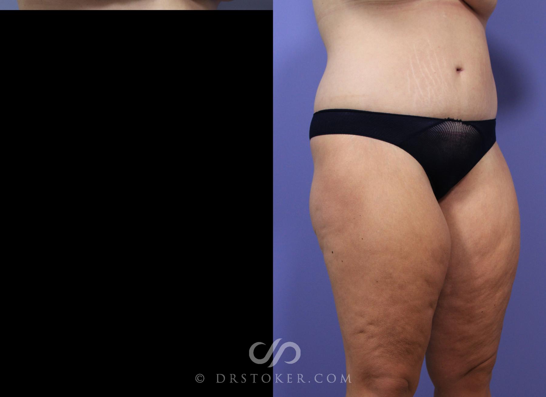 Before & After Body Lift Case 1005 View #2 View in Los Angeles, CA
