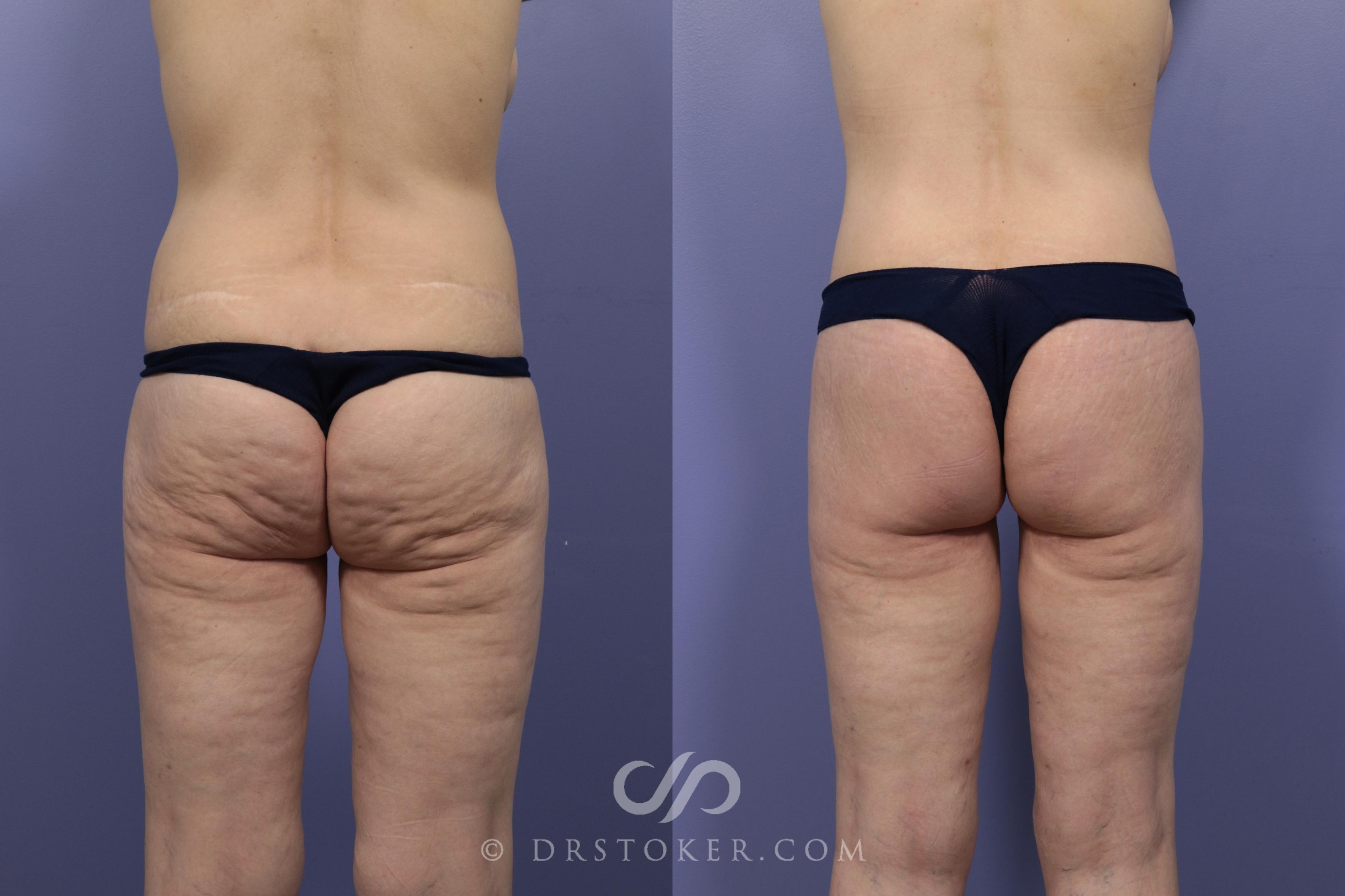 Before & After Body Lift Case 1007 View #1 View in Los Angeles, CA