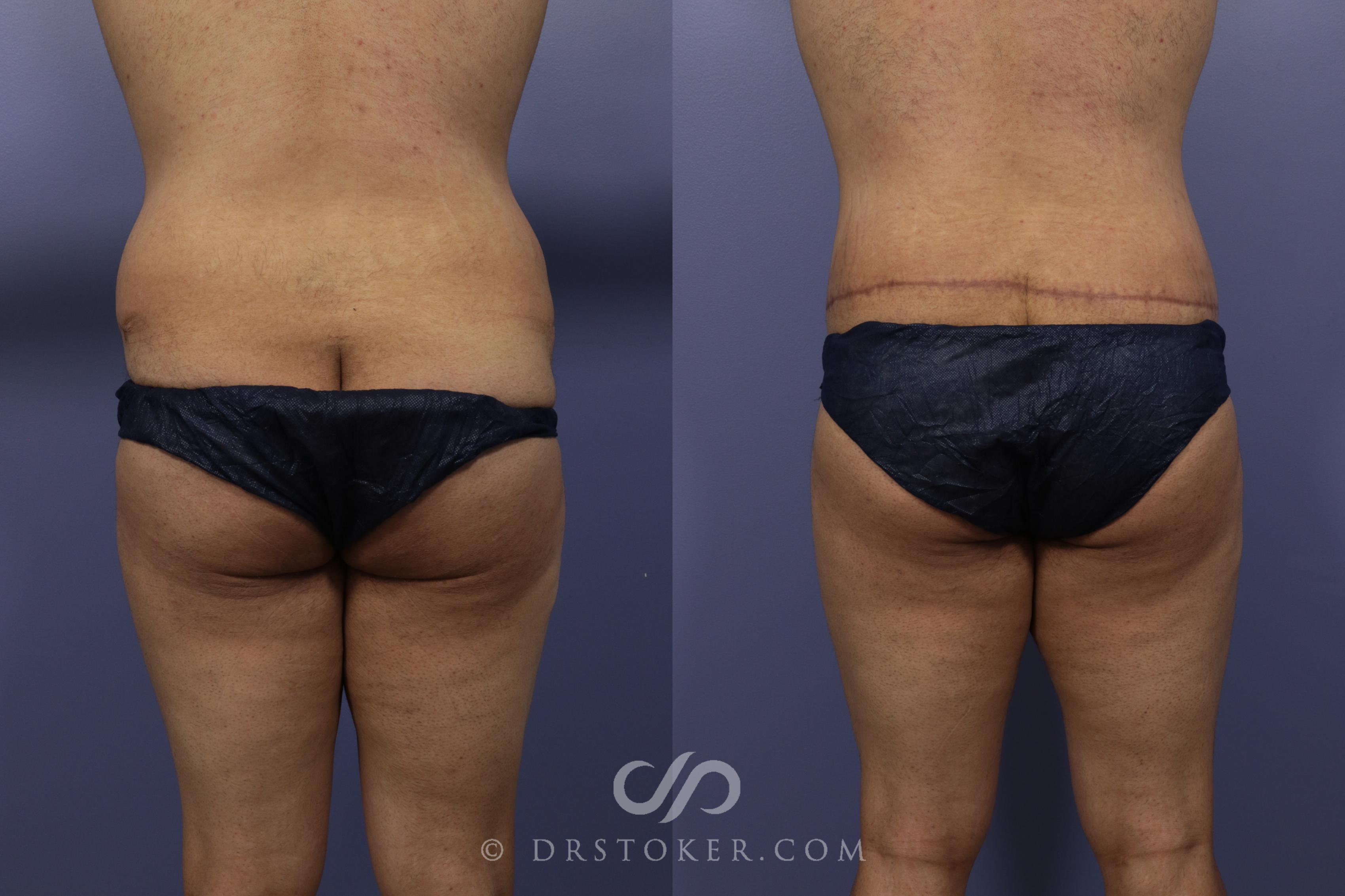 Body Lift Before and After Pictures Case 1003, Los Angeles, CA