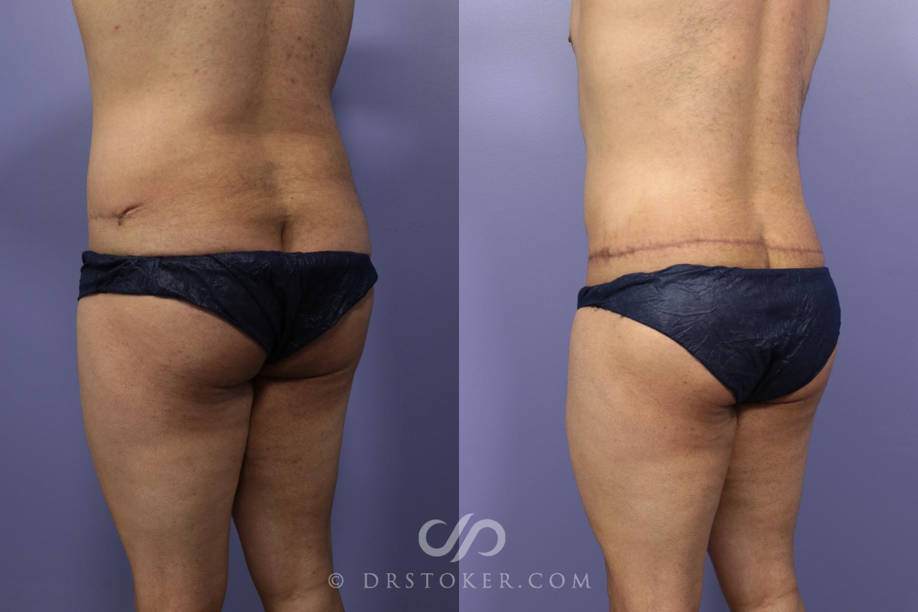 Before & After Body Lift Case 1009 View #2 View in Los Angeles, CA