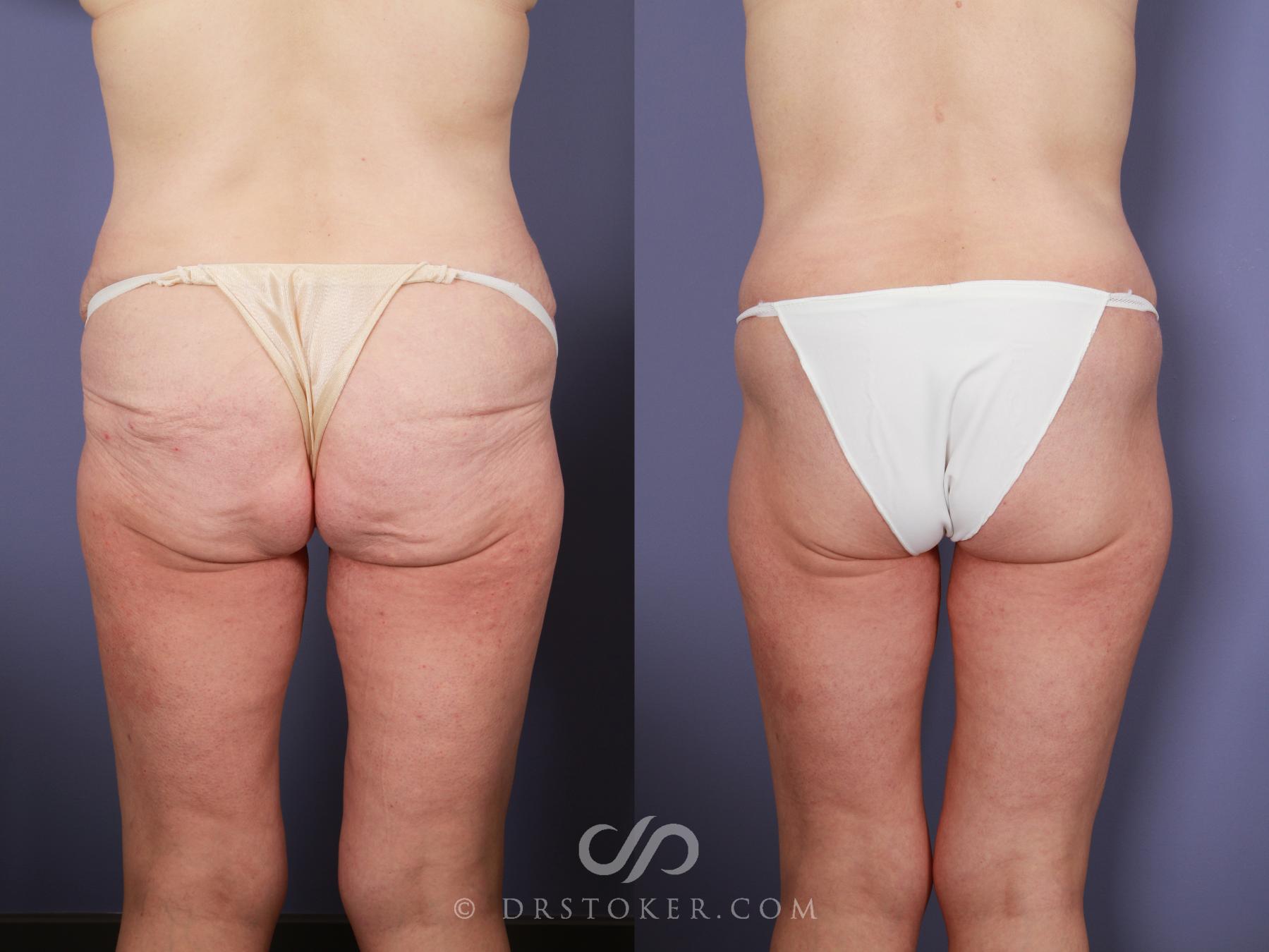 Before & After Body Lift Case 1010 View #1 View in Los Angeles, CA