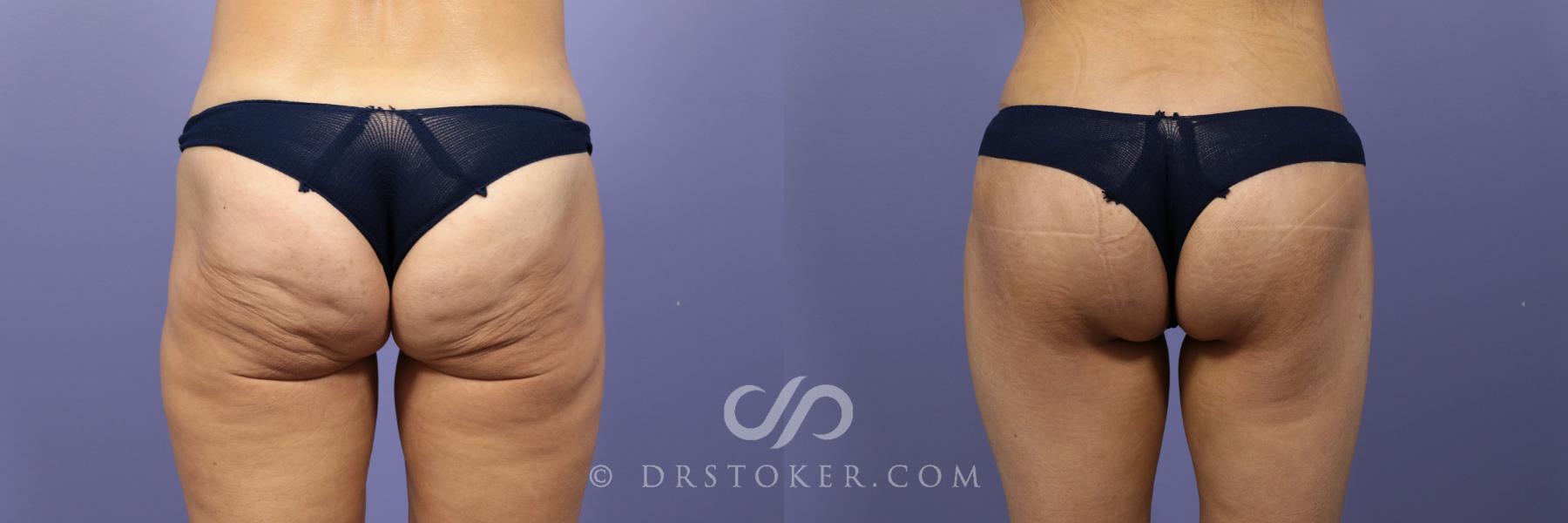 Before & After Body Lift Case 1012 View #1 View in Los Angeles, CA