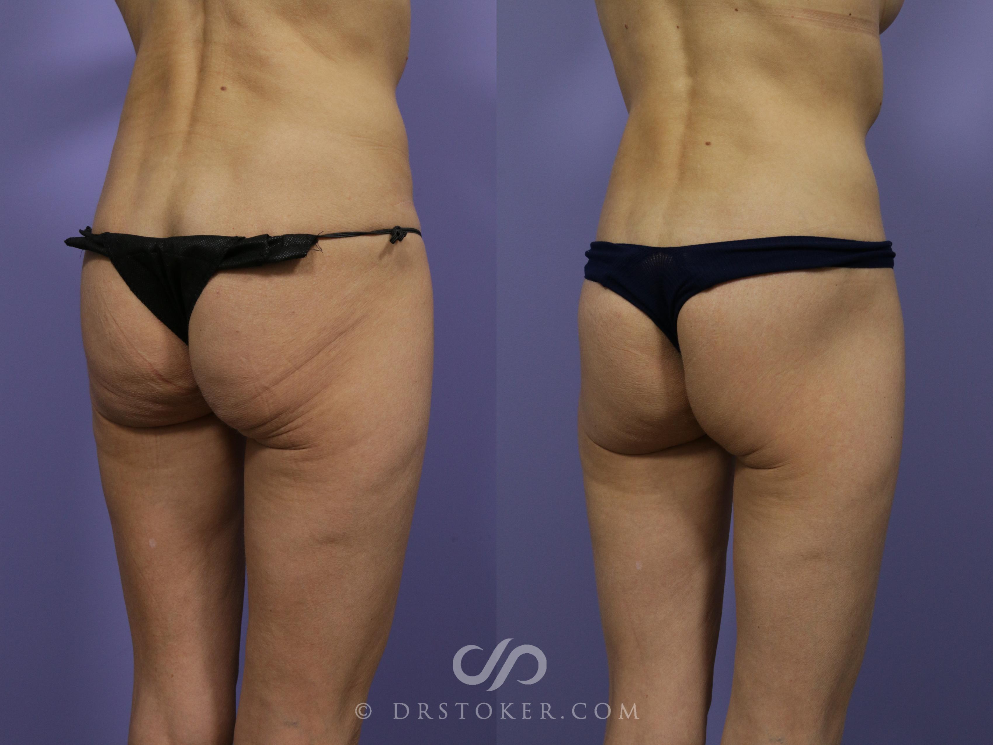 Before & After Lower Body Lift Case 1013 View #2 View in Los Angeles, CA