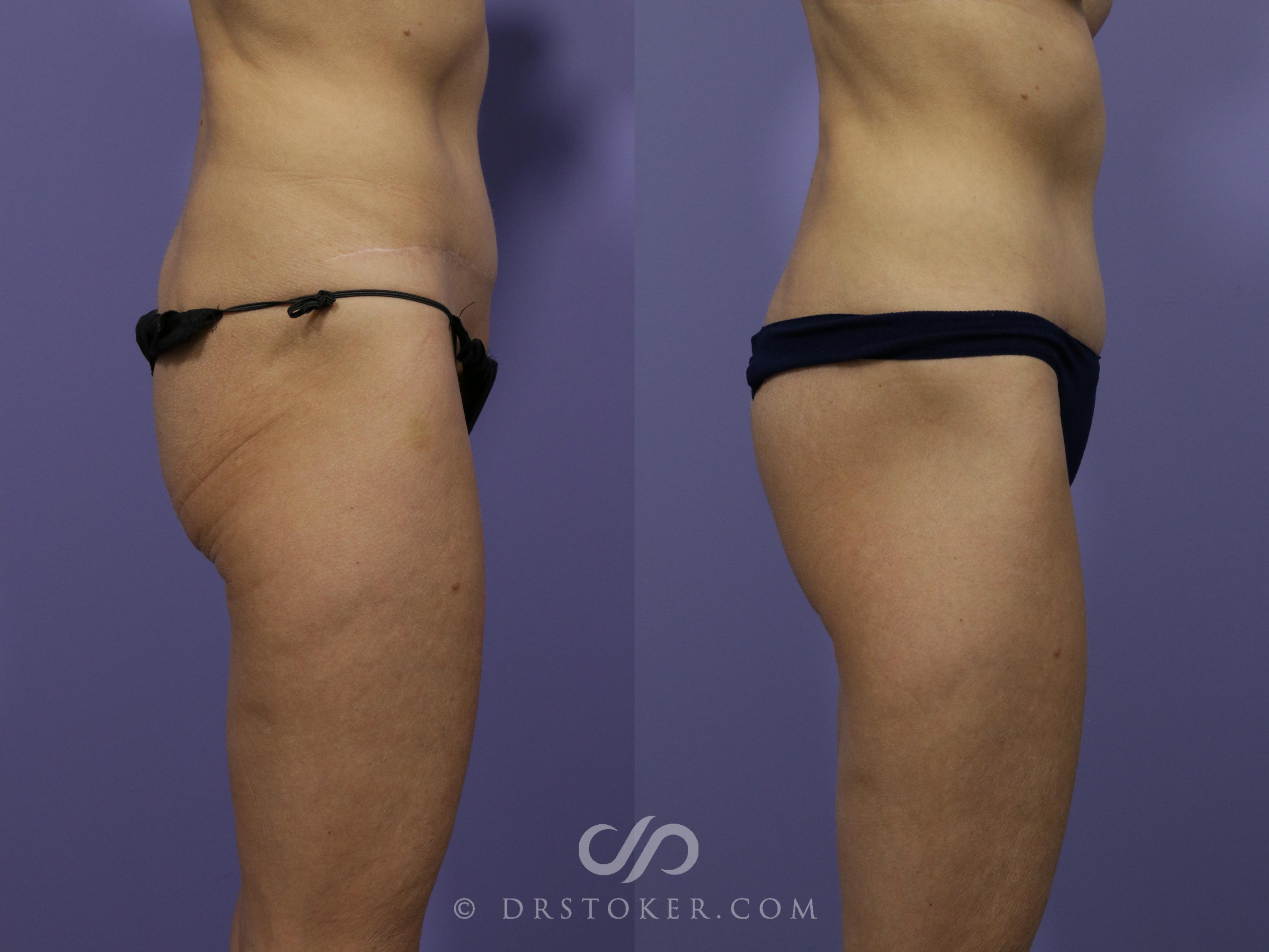 Before & After Lower Body Lift Case 1013 View #3 View in Los Angeles, CA