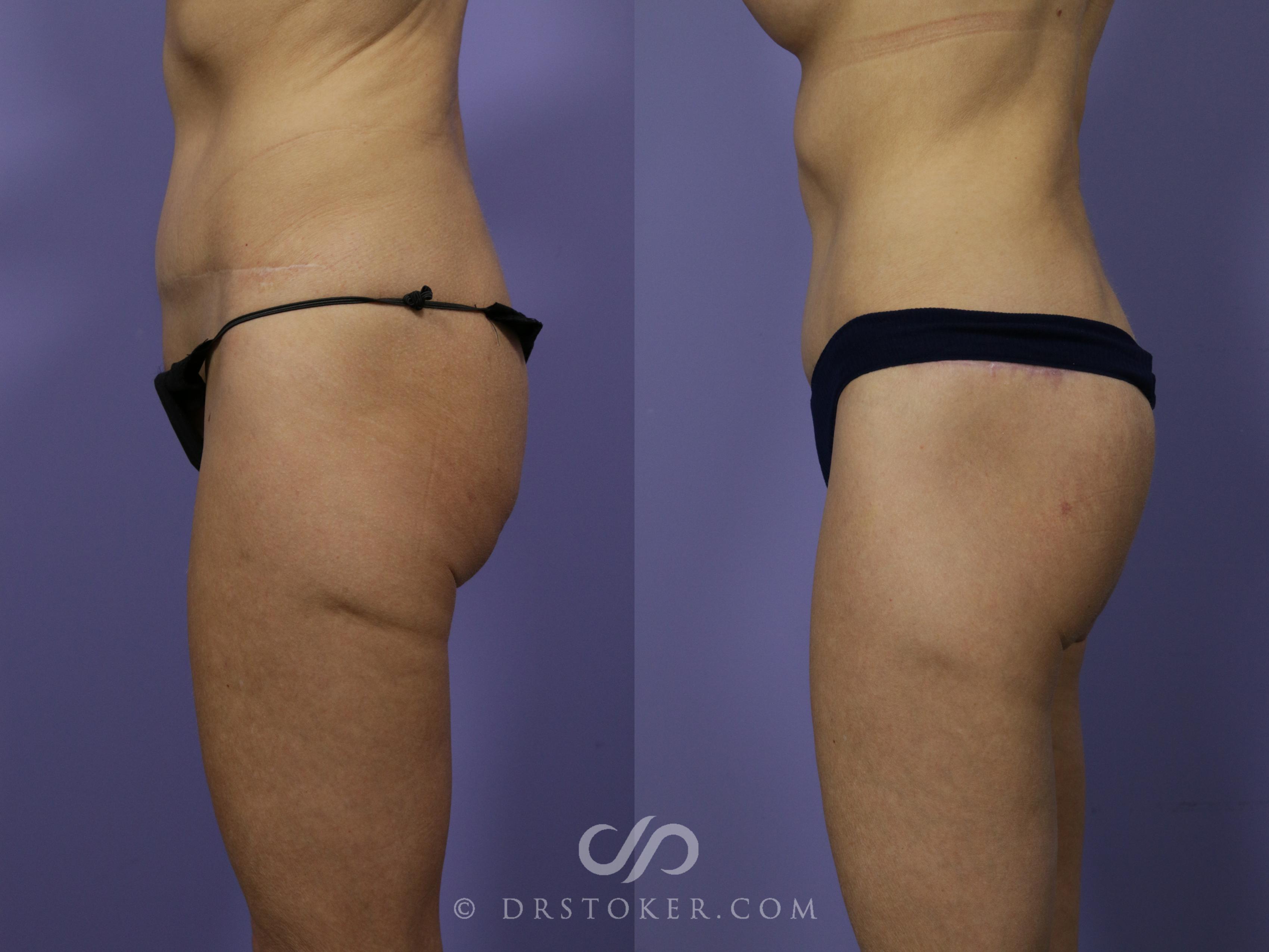 Before & After Body Lift Case 1014 View #2 View in Los Angeles, CA