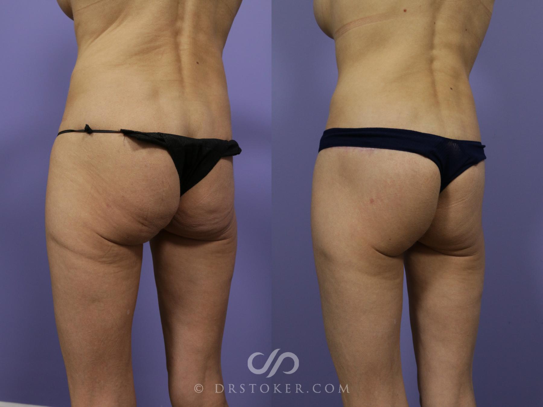 Before & After Body Lift Case 1014 View #3 View in Los Angeles, CA