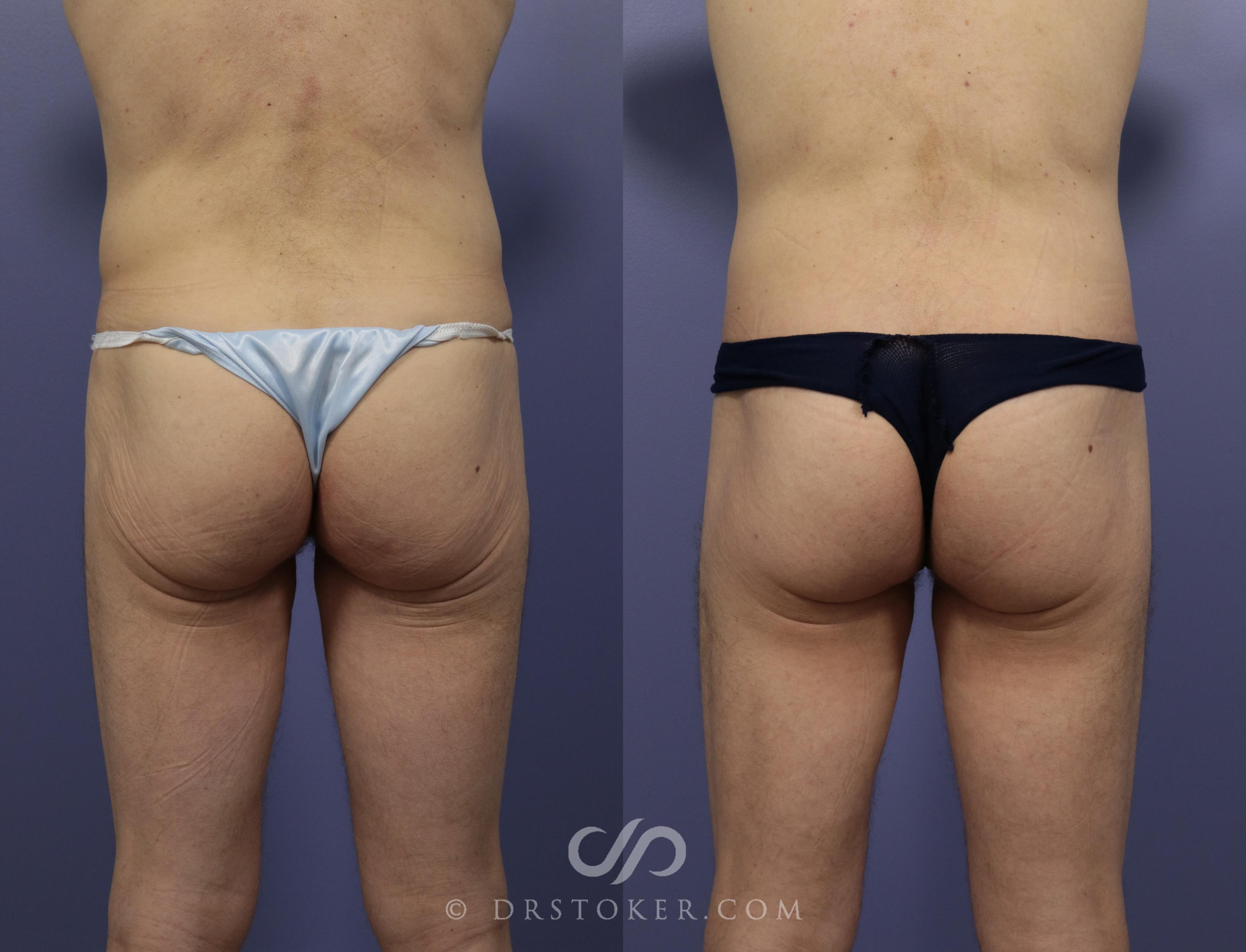 Before & After Body Lift Case 1158 View #1 View in Los Angeles, CA