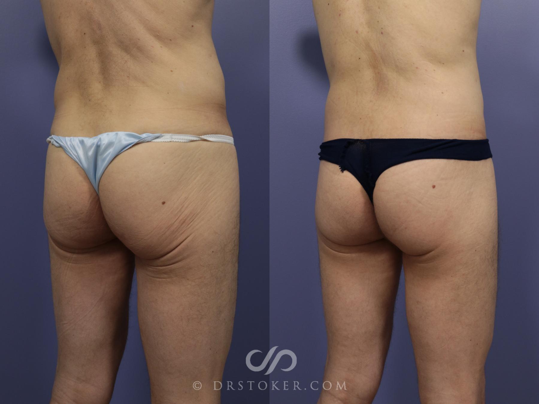 Before & After Body Lift Case 1158 View #2 View in Los Angeles, CA