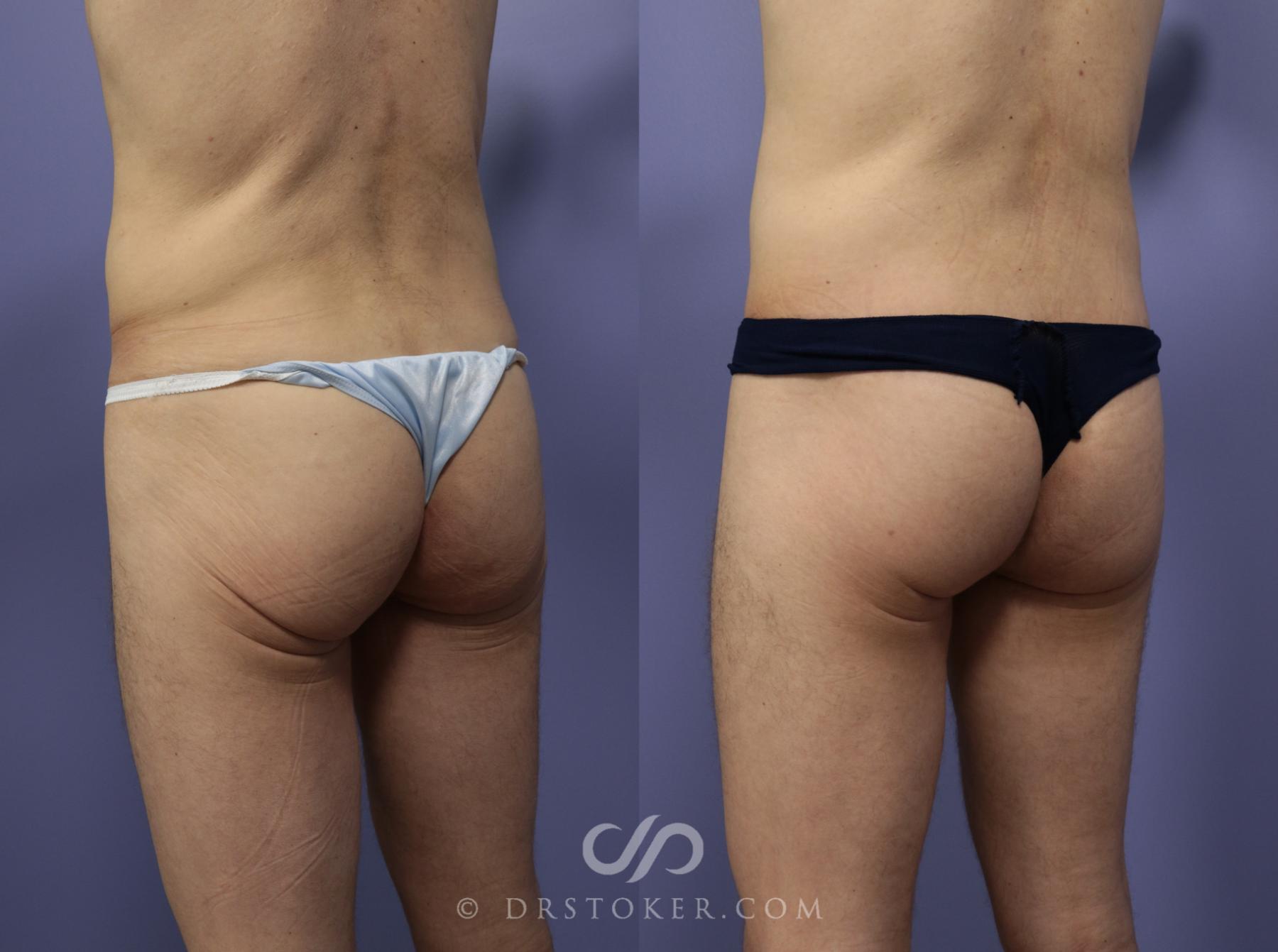 Before & After Body Lift Case 1158 View #3 View in Los Angeles, CA